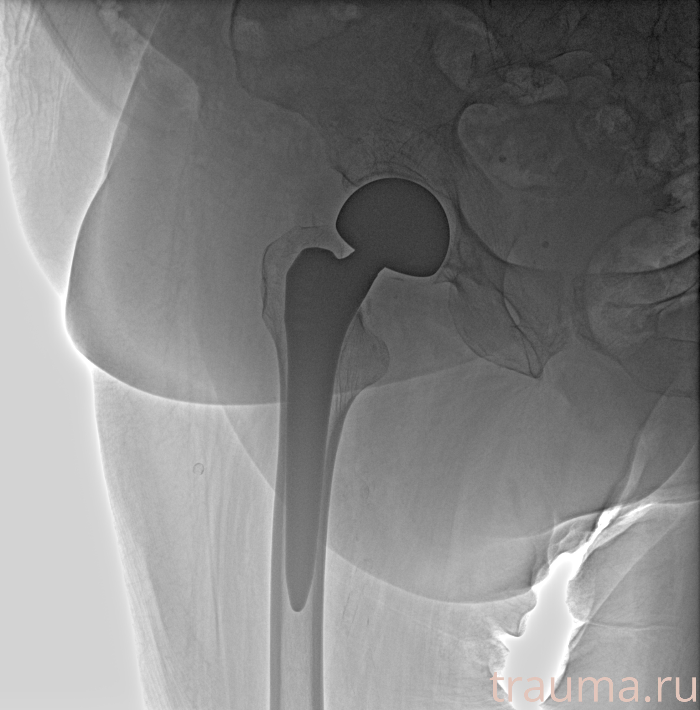 Рентген на дому: по вашему адресу приезжает врач-рентгенолог, травматолог-ортопед с мобильным рентгеновским аппаратом, проводит диагностику травмы или заболевания, делает необходимые рентгенограммы, дает рекомендации по дальнейшему лечению. Получить качественные снимки в домашних условиях возможно благодаря уникальной методике, разработанной МосРентген Центром для института  Склифосовского