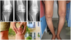 Лечение деформации костей голени, осложненной нестабильностью коленного сустава