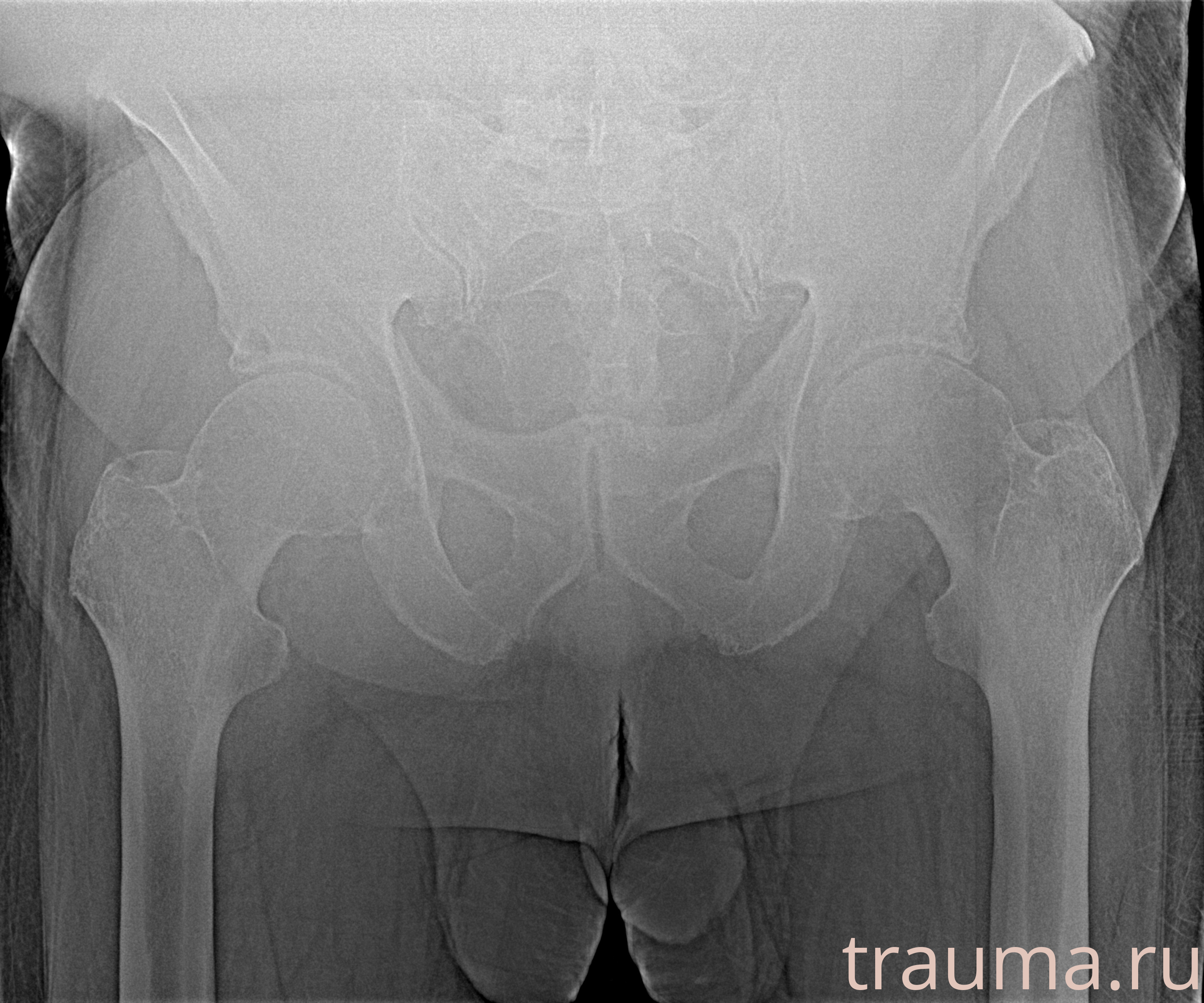 Рентген на дому: по вашему адресу приезжает врач-рентгенолог, травматолог-ортопед с мобильным рентгеновским аппаратом, проводит диагностику травмы или заболевания, делает необходимые рентгенограммы, дает рекомендации по дальнейшему лечению. Получить качественные снимки в домашних условиях возможно благодаря уникальной методике, разработанной МосРентген Центром для института  Склифосовского