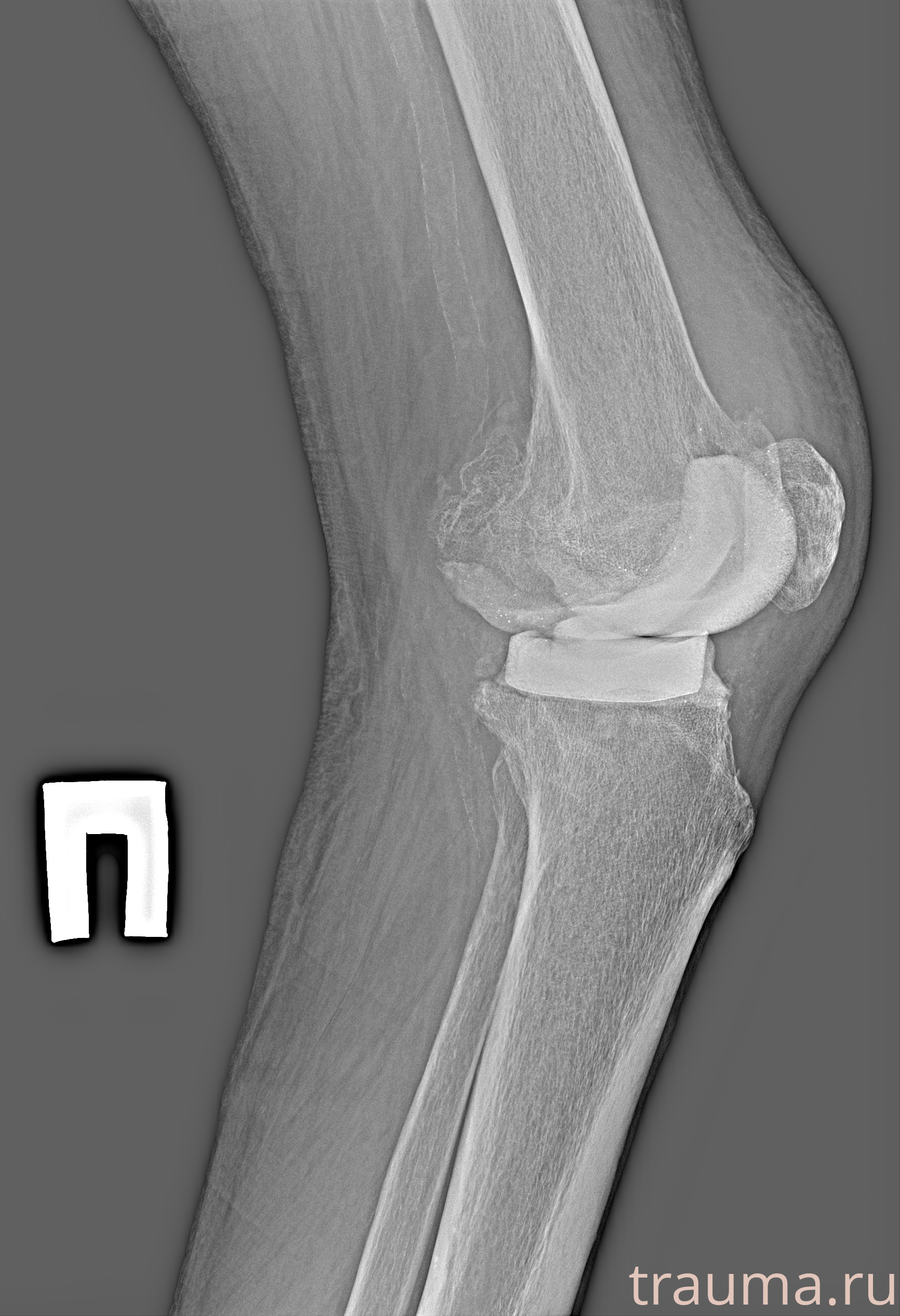 Рентген на дому: по вашему адресу приезжает врач-рентгенолог, травматолог-ортопед с мобильным рентгеновским аппаратом, проводит диагностику травмы или заболевания, делает необходимые рентгенограммы, дает рекомендации по дальнейшему лечению. Получить качественные снимки в домашних условиях возможно благодаря уникальной методике, разработанной МосРентген Центром для института  Склифосовского
