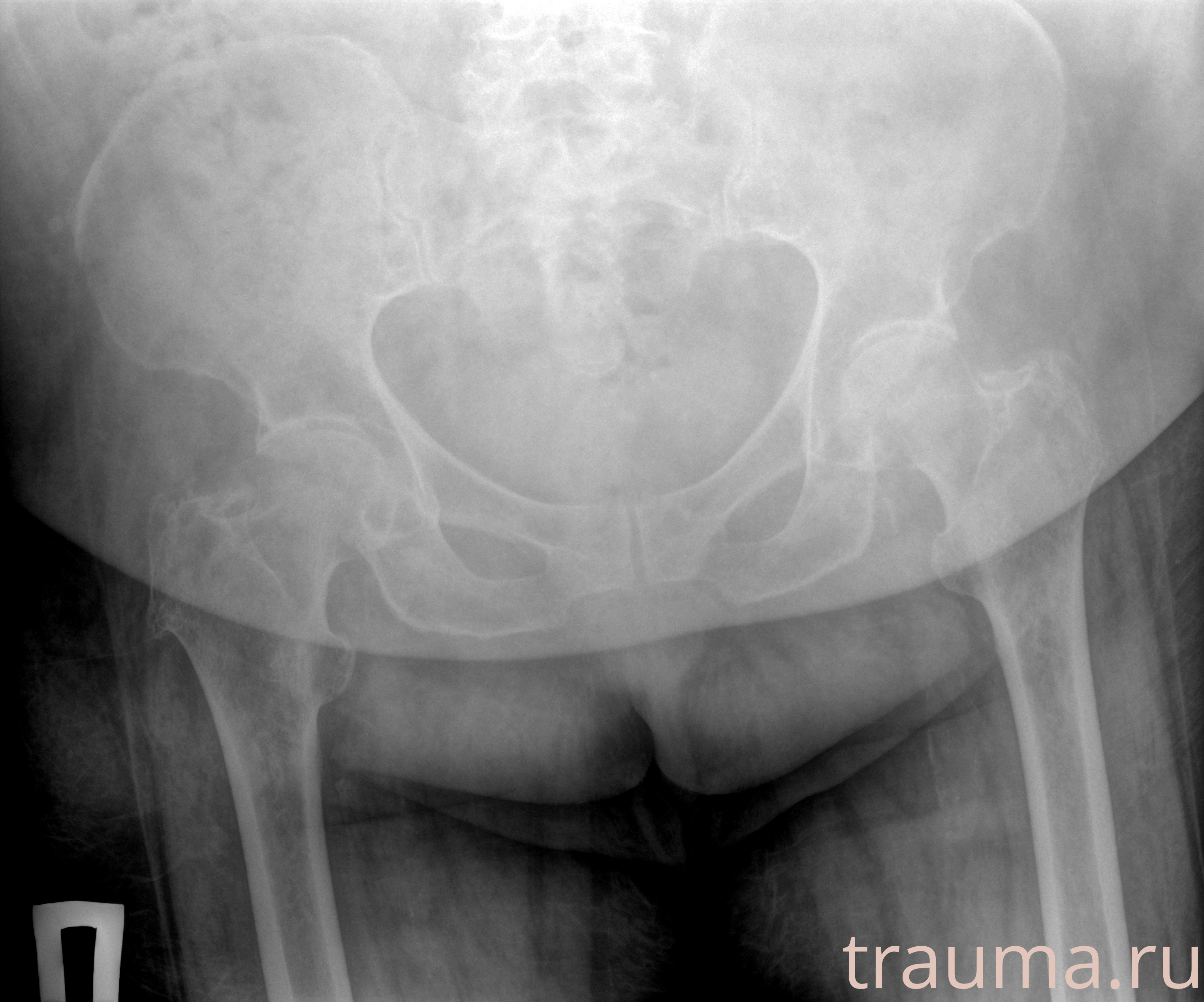 Рентген на дому: по вашему адресу приезжает врач-рентгенолог, травматолог-ортопед с мобильным рентгеновским аппаратом, проводит диагностику травмы или заболевания, делает необходимые рентгенограммы, дает рекомендации по дальнейшему лечению. Получить качественные снимки в домашних условиях возможно благодаря уникальной методике, разработанной МосРентген Центром для института  Склифосовского