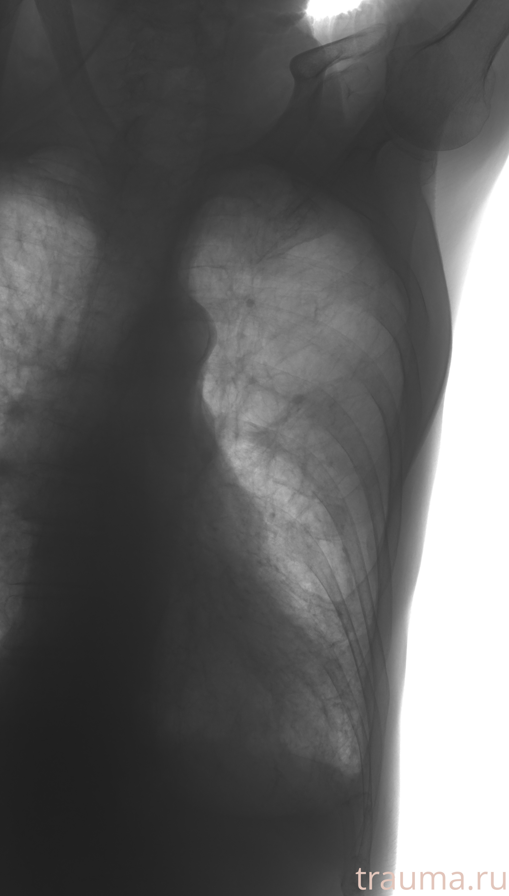 Рентген на дому: по вашему адресу приезжает врач-рентгенолог, травматолог-ортопед с мобильным рентгеновским аппаратом, проводит диагностику травмы или заболевания, делает необходимые рентгенограммы, дает рекомендации по дальнейшему лечению. Получить качественные снимки в домашних условиях возможно благодаря уникальной методике, разработанной МосРентген Центром для института  Склифосовского