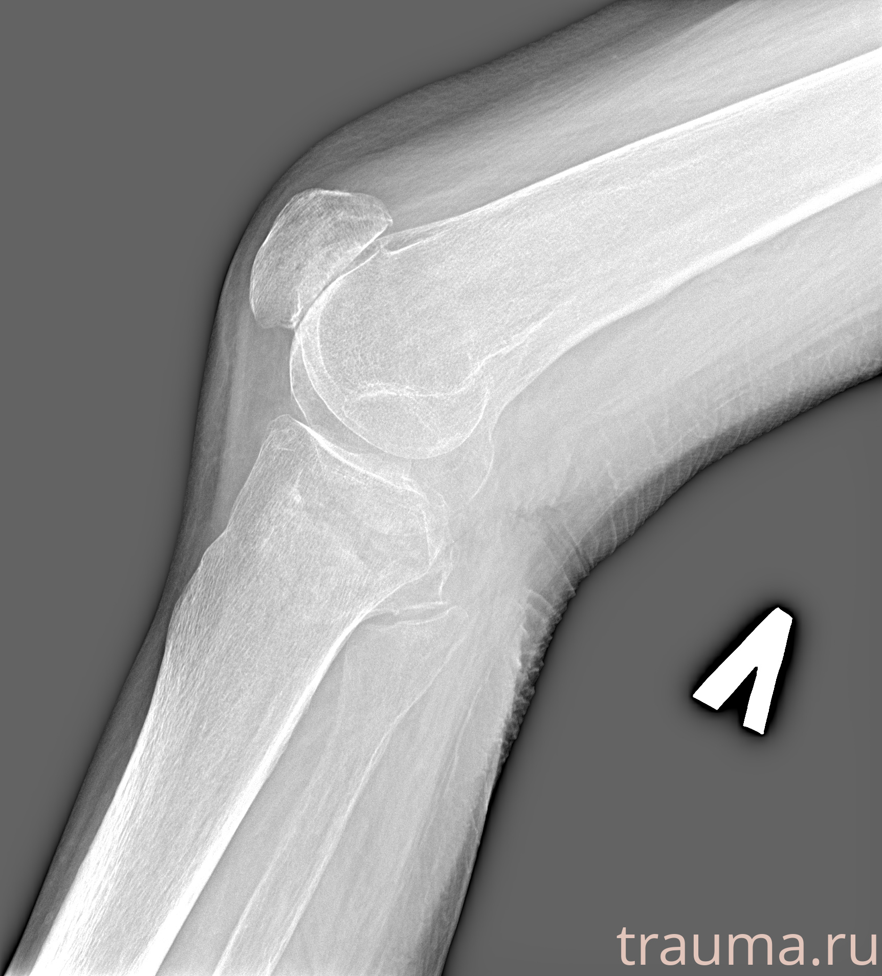 Рентген на дому: по вашему адресу приезжает врач-рентгенолог, травматолог-ортопед с мобильным рентгеновским аппаратом, проводит диагностику травмы или заболевания, делает необходимые рентгенограммы, дает рекомендации по дальнейшему лечению. Получить качественные снимки в домашних условиях возможно благодаря уникальной методике, разработанной МосРентген Центром для института  Склифосовского