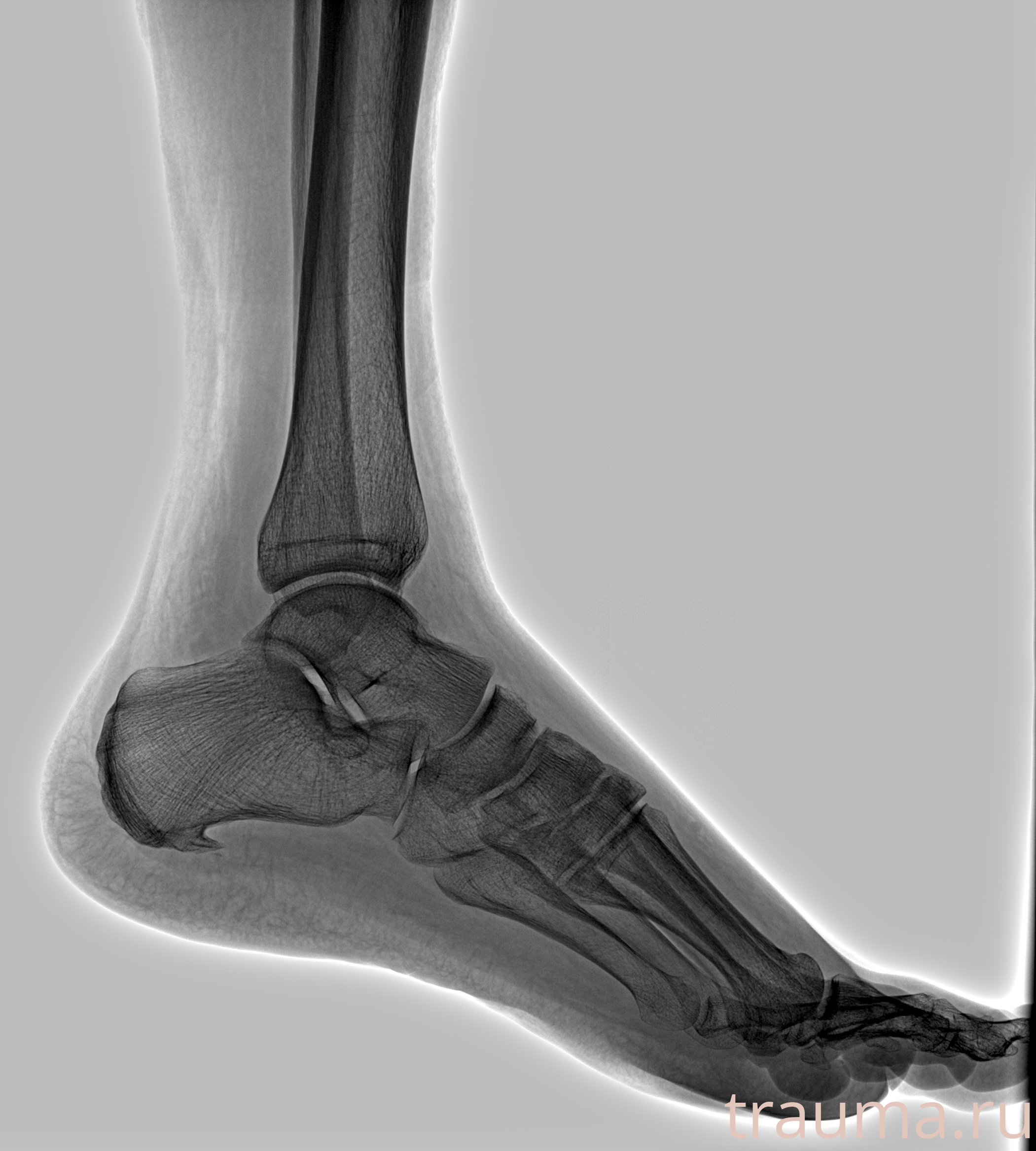 Рентген на дому: по вашему адресу приезжает врач-рентгенолог, травматолог-ортопед с мобильным рентгеновским аппаратом, проводит диагностику травмы или заболевания, делает необходимые рентгенограммы, дает рекомендации по дальнейшему лечению. Получить качественные снимки в домашних условиях возможно благодаря уникальной методике, разработанной МосРентген Центром для института  Склифосовского