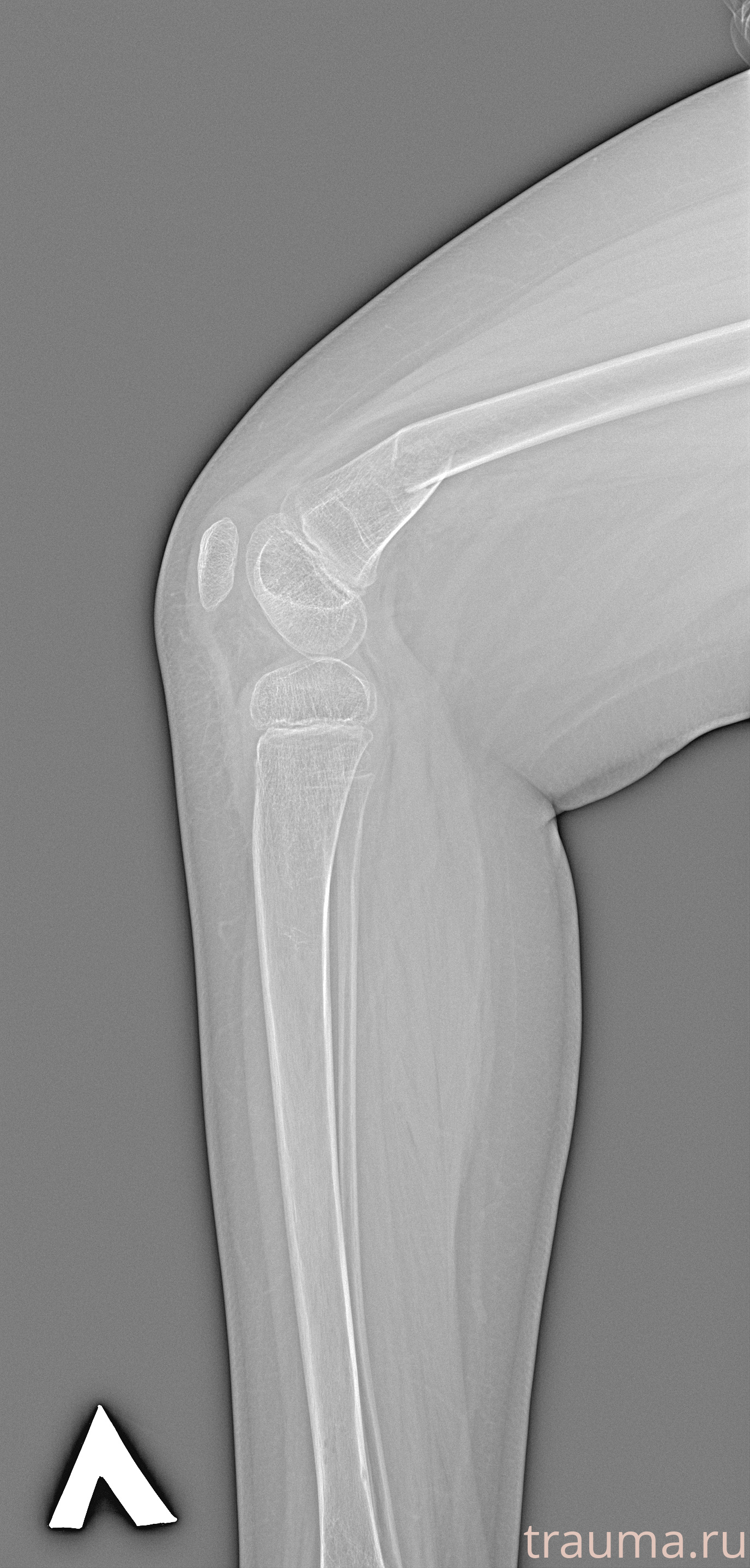 Рентген на дому: по вашему адресу приезжает врач-рентгенолог, травматолог-ортопед с мобильным рентгеновским аппаратом, проводит диагностику травмы или заболевания, делает необходимые рентгенограммы, дает рекомендации по дальнейшему лечению. Получить качественные снимки в домашних условиях возможно благодаря уникальной методике, разработанной МосРентген Центром для института  Склифосовского