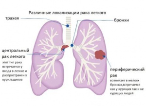  Дифференциальная рентгенодиагностика заболеваний органов дыхания и средостения(Часть 1)