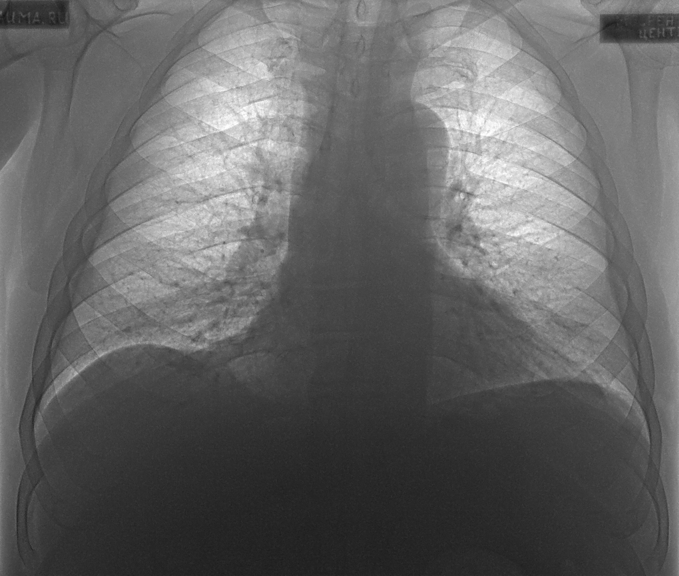 Двухсторонняя очаговая пневмония рентген