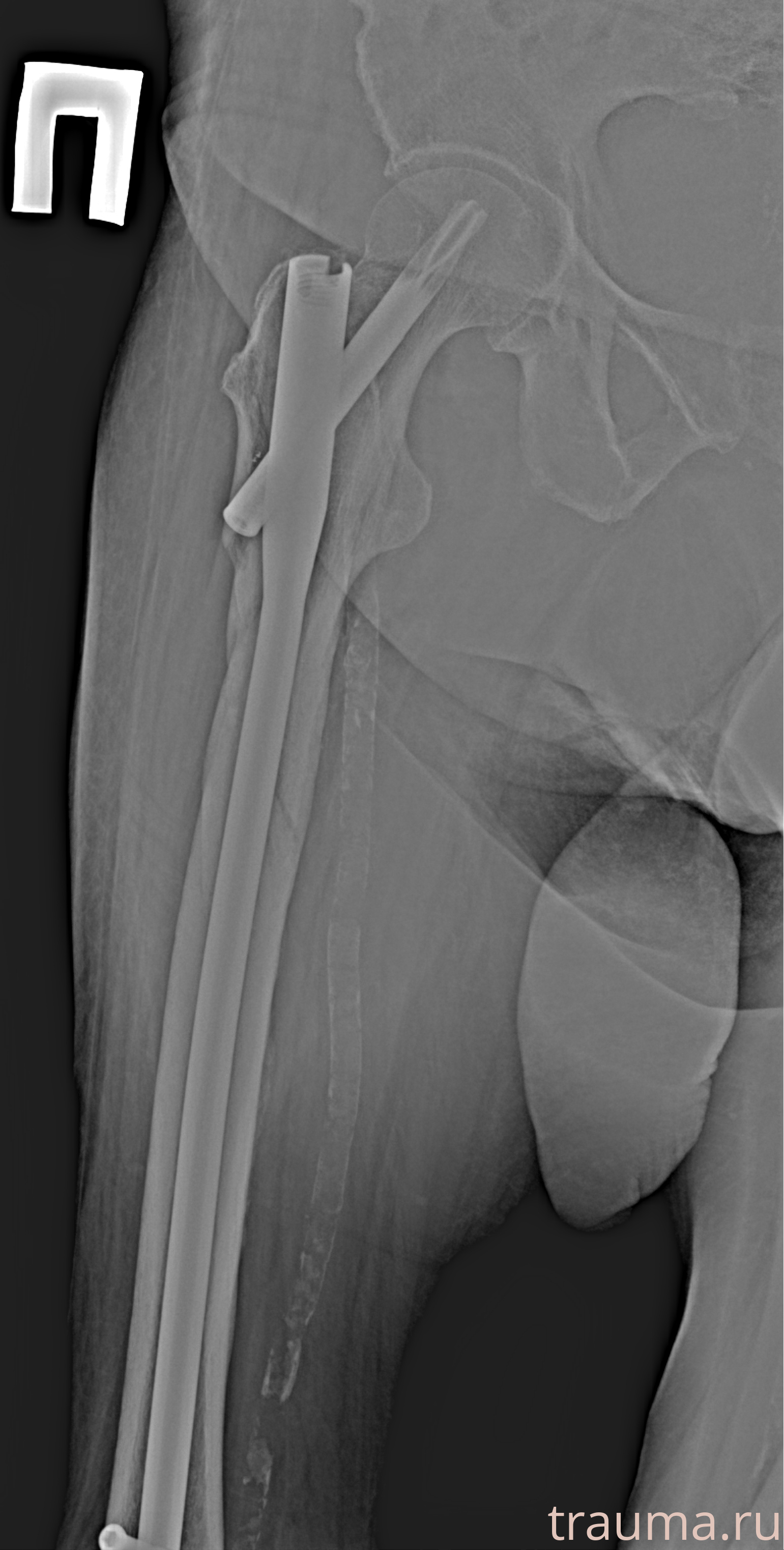 Рентген на дому: по вашему адресу приезжает врач-рентгенолог, травматолог-ортопед с мобильным рентгеновским аппаратом, проводит диагностику травмы или заболевания, делает необходимые рентгенограммы, дает рекомендации по дальнейшему лечению. Получить качественные снимки в домашних условиях возможно благодаря уникальной методике, разработанной МосРентген Центром для института  Склифосовского