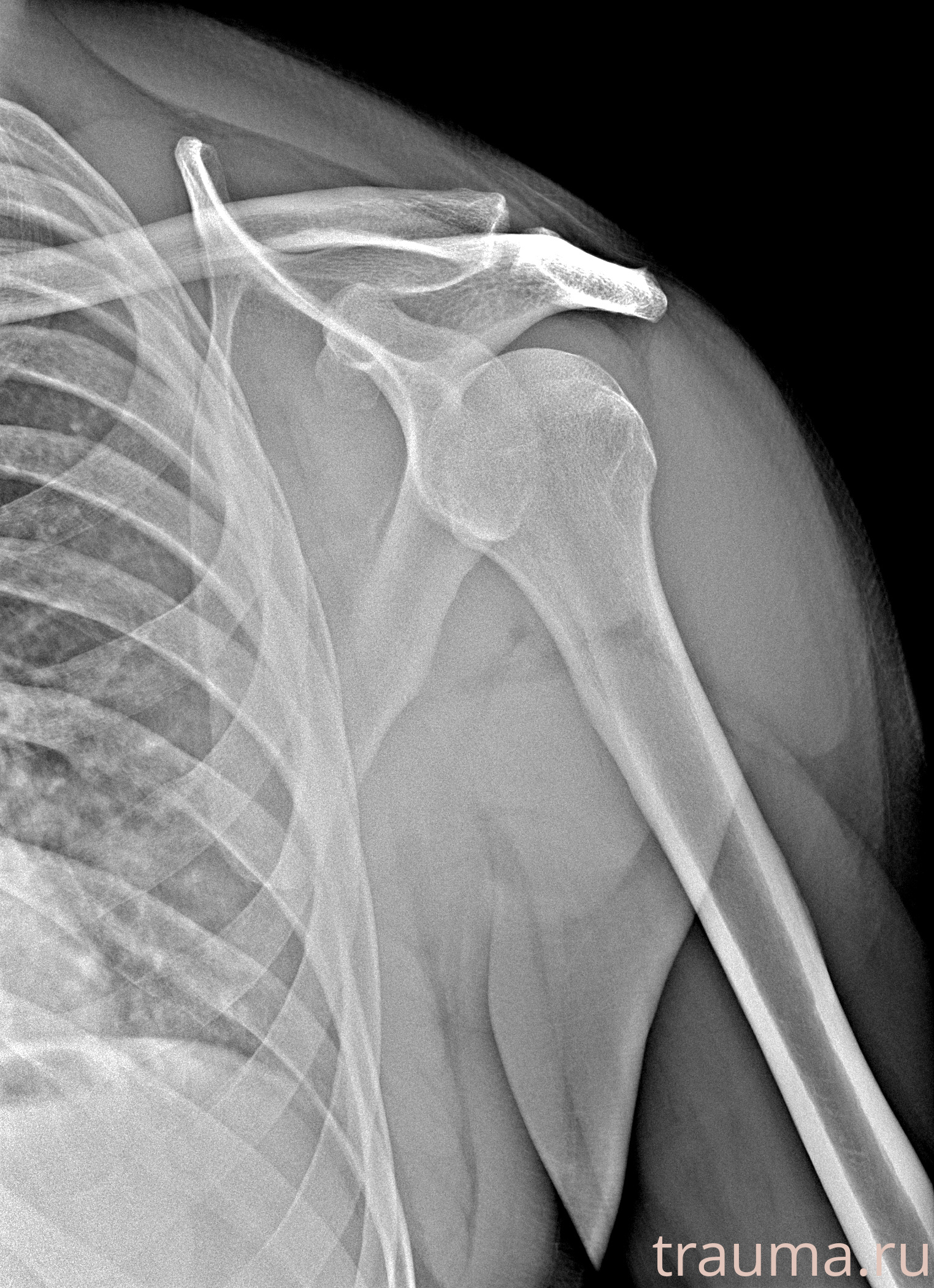 Рентген на дому: по вашему адресу приезжает врач-рентгенолог, травматолог-ортопед с мобильным рентгеновским аппаратом, проводит диагностику травмы или заболевания, делает необходимые рентгенограммы, дает рекомендации по дальнейшему лечению. Получить качественные снимки в домашних условиях возможно благодаря уникальной методике, разработанной МосРентген Центром для института  Склифосовского