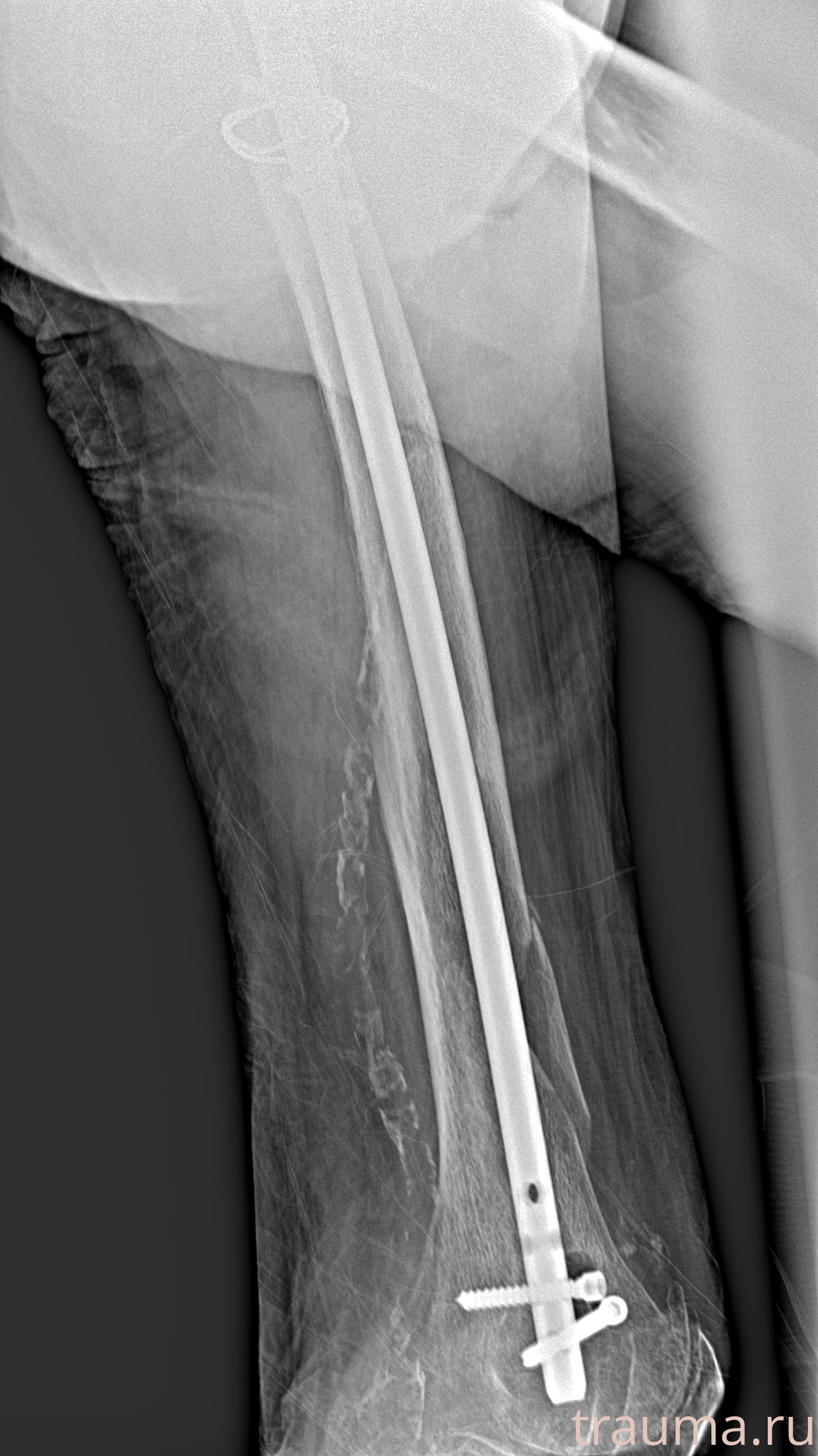 Рентген на дому: по вашему адресу приезжает врач-рентгенолог, травматолог-ортопед с мобильным рентгеновским аппаратом, проводит диагностику травмы или заболевания, делает необходимые рентгенограммы, дает рекомендации по дальнейшему лечению. Получить качественные снимки в домашних условиях возможно благодаря уникальной методике, разработанной МосРентген Центром для института  Склифосовского