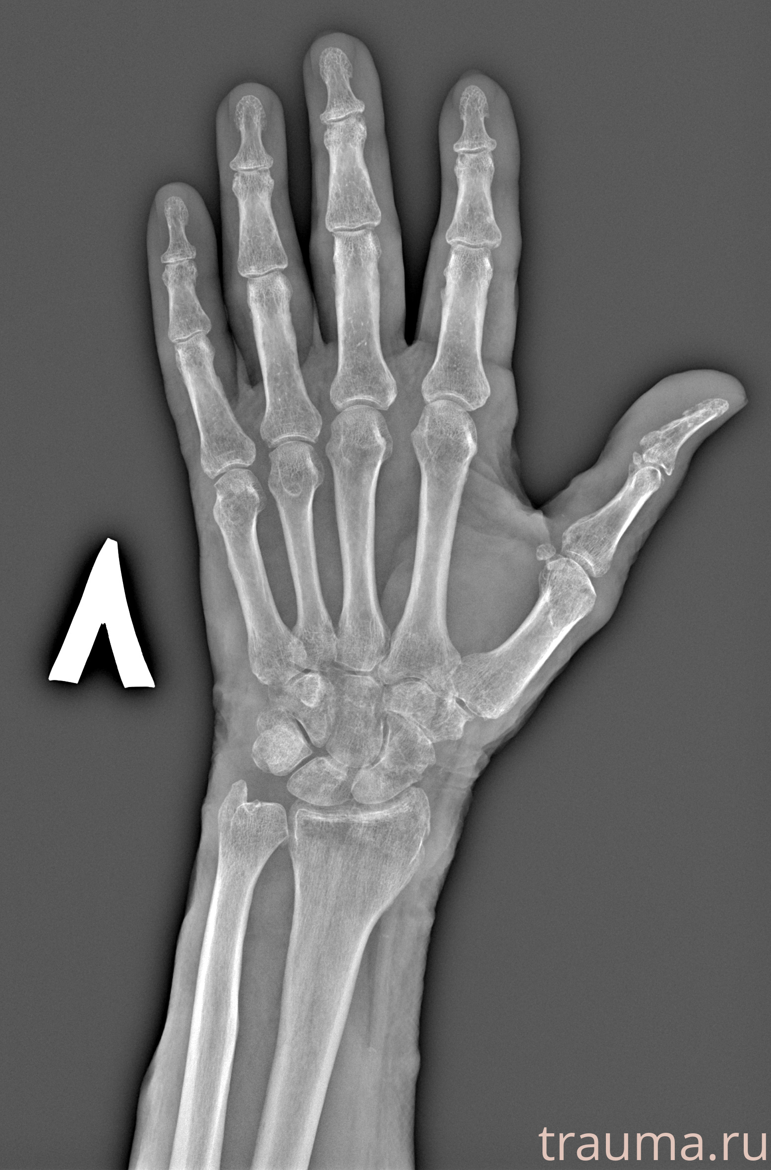 Рентген на дому: по вашему адресу приезжает врач-рентгенолог, травматолог-ортопед с мобильным рентгеновским аппаратом, проводит диагностику травмы или заболевания, делает необходимые рентгенограммы, дает рекомендации по дальнейшему лечению. Получить качественные снимки в домашних условиях возможно благодаря уникальной методике, разработанной МосРентген Центром для института  Склифосовского