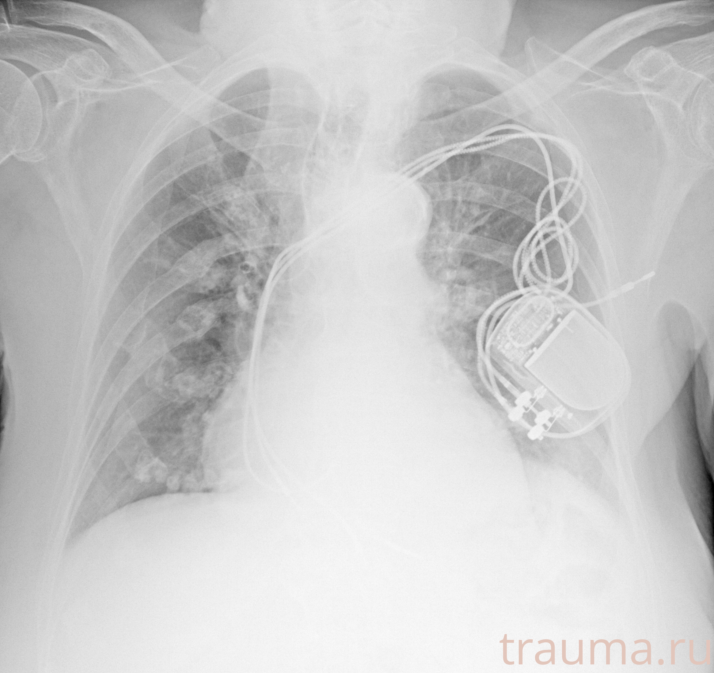 Рентген на дому: по вашему адресу приезжает врач-рентгенолог, травматолог-ортопед с мобильным рентгеновским аппаратом, проводит диагностику травмы или заболевания, делает необходимые рентгенограммы, дает рекомендации по дальнейшему лечению. Получить качественные снимки в домашних условиях возможно благодаря уникальной методике, разработанной МосРентген Центром для института  Склифосовского