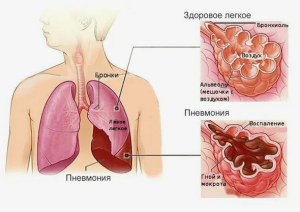 Показатели системного воспаления у больных внегоспитальной пневмонией на фоне хронической патологии гепатобилярной системы 

