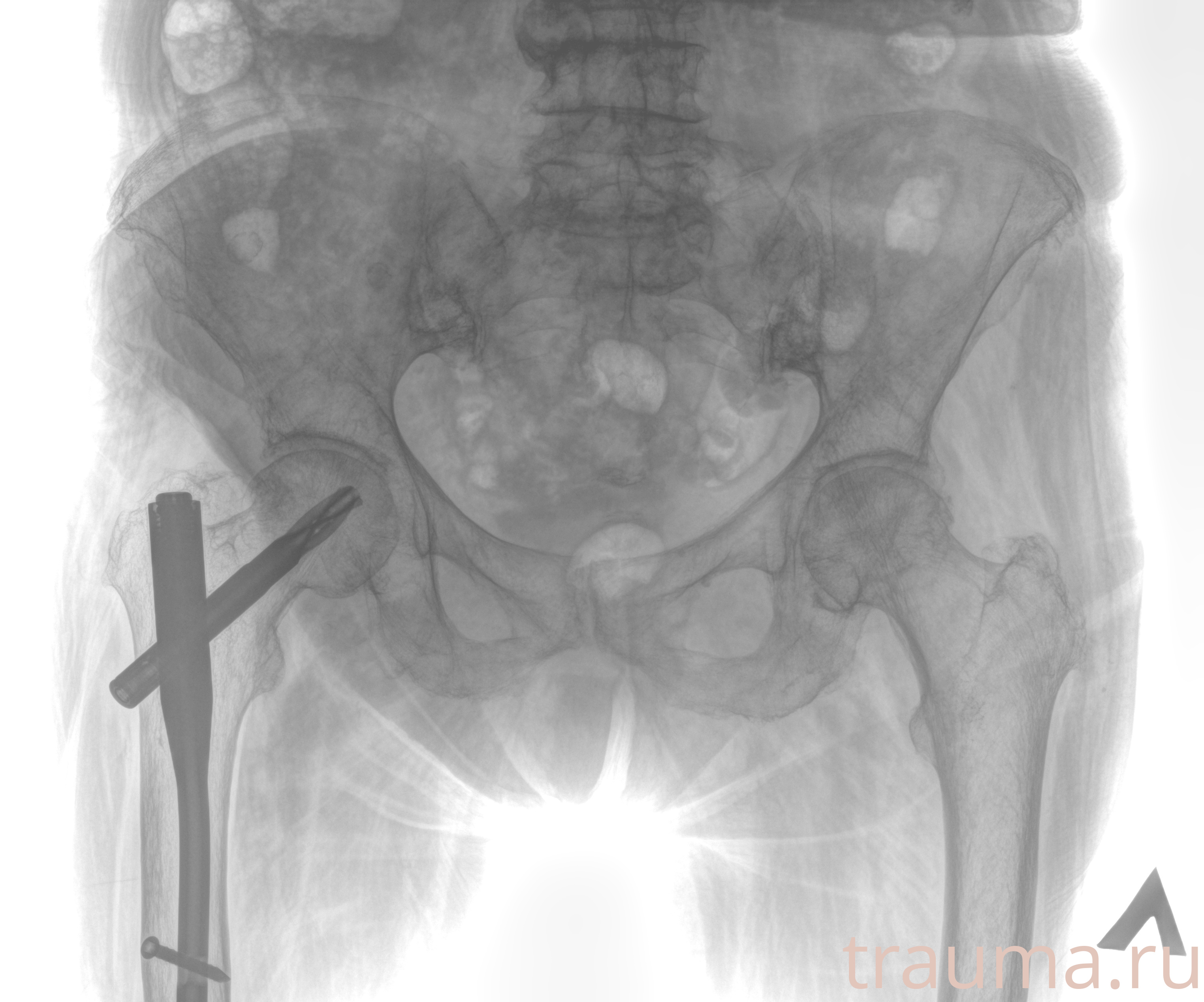 Рентген на дому: по вашему адресу приезжает врач-рентгенолог, травматолог-ортопед с мобильным рентгеновским аппаратом, проводит диагностику травмы или заболевания, делает необходимые рентгенограммы, дает рекомендации по дальнейшему лечению. Получить качественные снимки в домашних условиях возможно благодаря уникальной методике, разработанной МосРентген Центром для института  Склифосовского