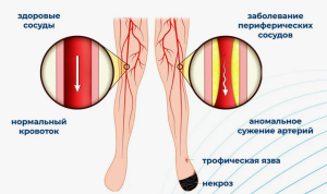 Хроническая ишемия нижних конечностей с клиникой перемежающейся хромоты (ПХ)

