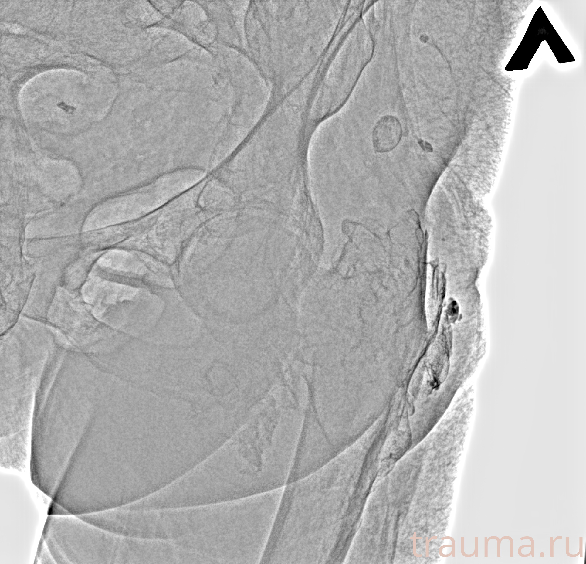 Рентген на дому: по вашему адресу приезжает врач-рентгенолог, травматолог-ортопед с мобильным рентгеновским аппаратом, проводит диагностику травмы или заболевания, делает необходимые рентгенограммы, дает рекомендации по дальнейшему лечению. Получить качественные снимки в домашних условиях возможно благодаря уникальной методике, разработанной МосРентген Центром для института  Склифосовского