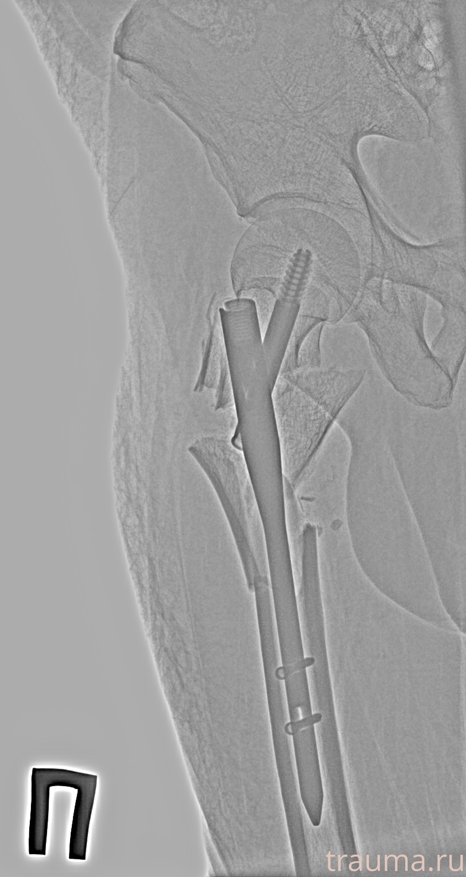 Рентген на дому: по вашему адресу приезжает врач-рентгенолог, травматолог-ортопед с мобильным рентгеновским аппаратом, проводит диагностику травмы или заболевания, делает необходимые рентгенограммы, дает рекомендации по дальнейшему лечению. Получить качественные снимки в домашних условиях возможно благодаря уникальной методике, разработанной МосРентген Центром для института  Склифосовского