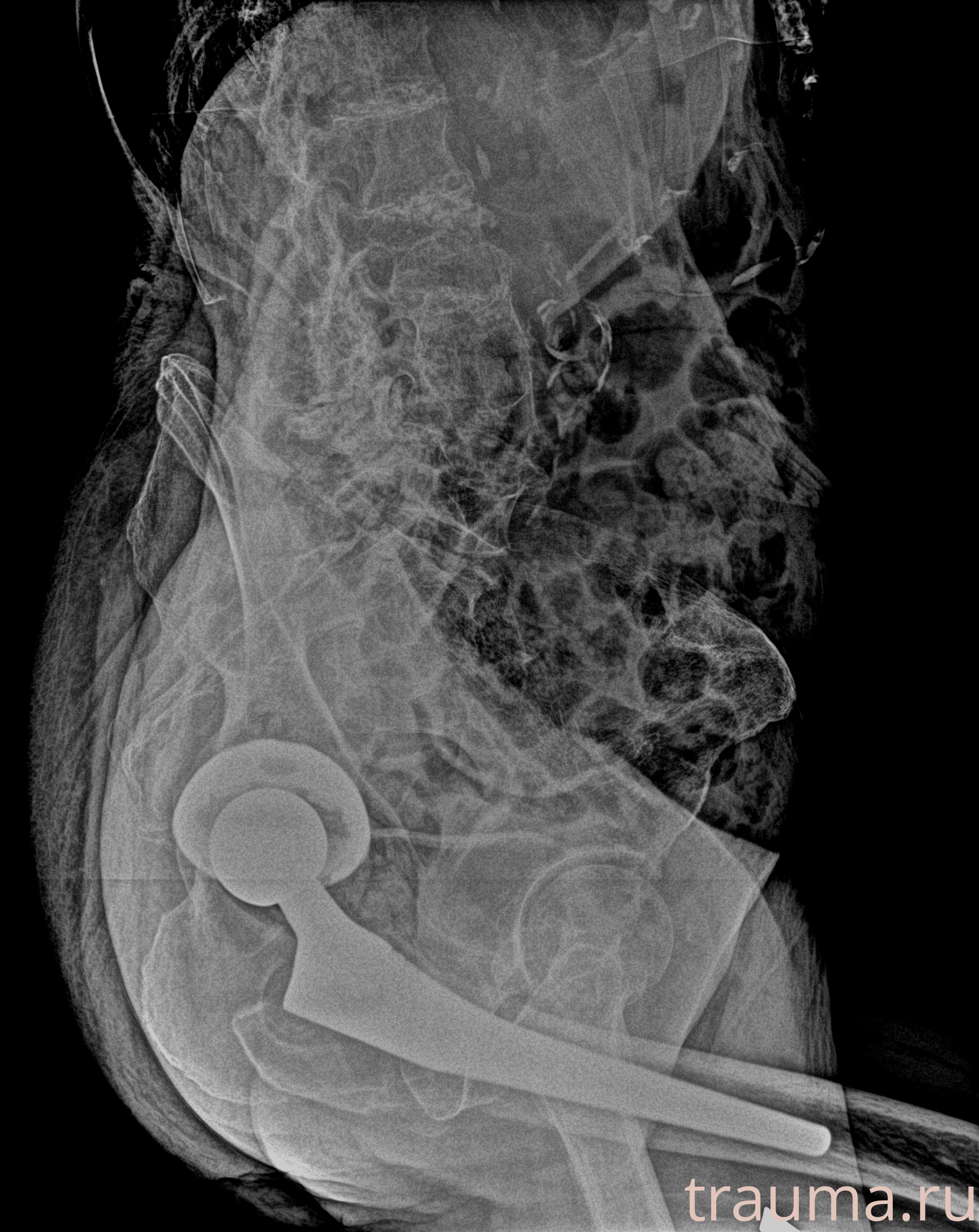 Рентген на дому: по вашему адресу приезжает врач-рентгенолог, травматолог-ортопед с мобильным рентгеновским аппаратом, проводит диагностику травмы или заболевания, делает необходимые рентгенограммы, дает рекомендации по дальнейшему лечению. Получить качественные снимки в домашних условиях возможно благодаря уникальной методике, разработанной МосРентген Центром для института  Склифосовского