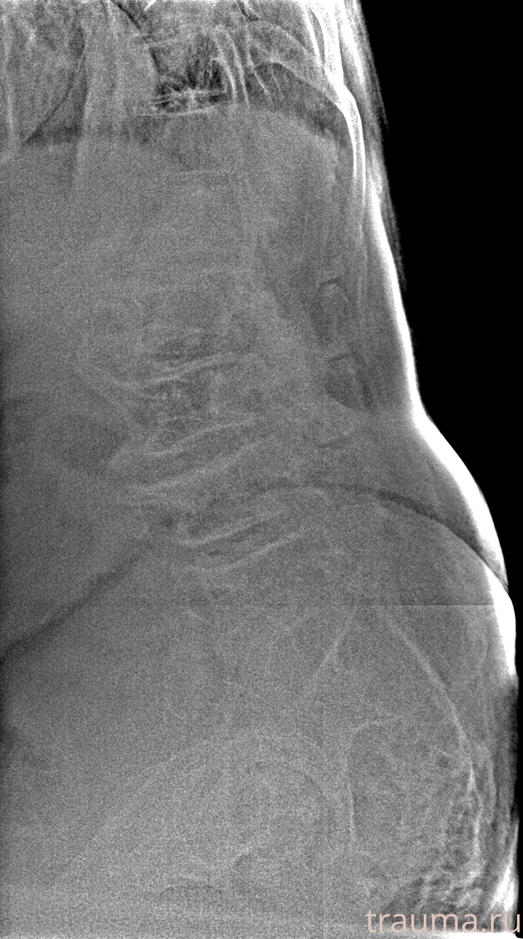 Рентген на дому: по вашему адресу приезжает врач-рентгенолог, травматолог-ортопед с мобильным рентгеновским аппаратом, проводит диагностику травмы или заболевания, делает необходимые рентгенограммы, дает рекомендации по дальнейшему лечению. Получить качественные снимки в домашних условиях возможно благодаря уникальной методике, разработанной МосРентген Центром для института  Склифосовского