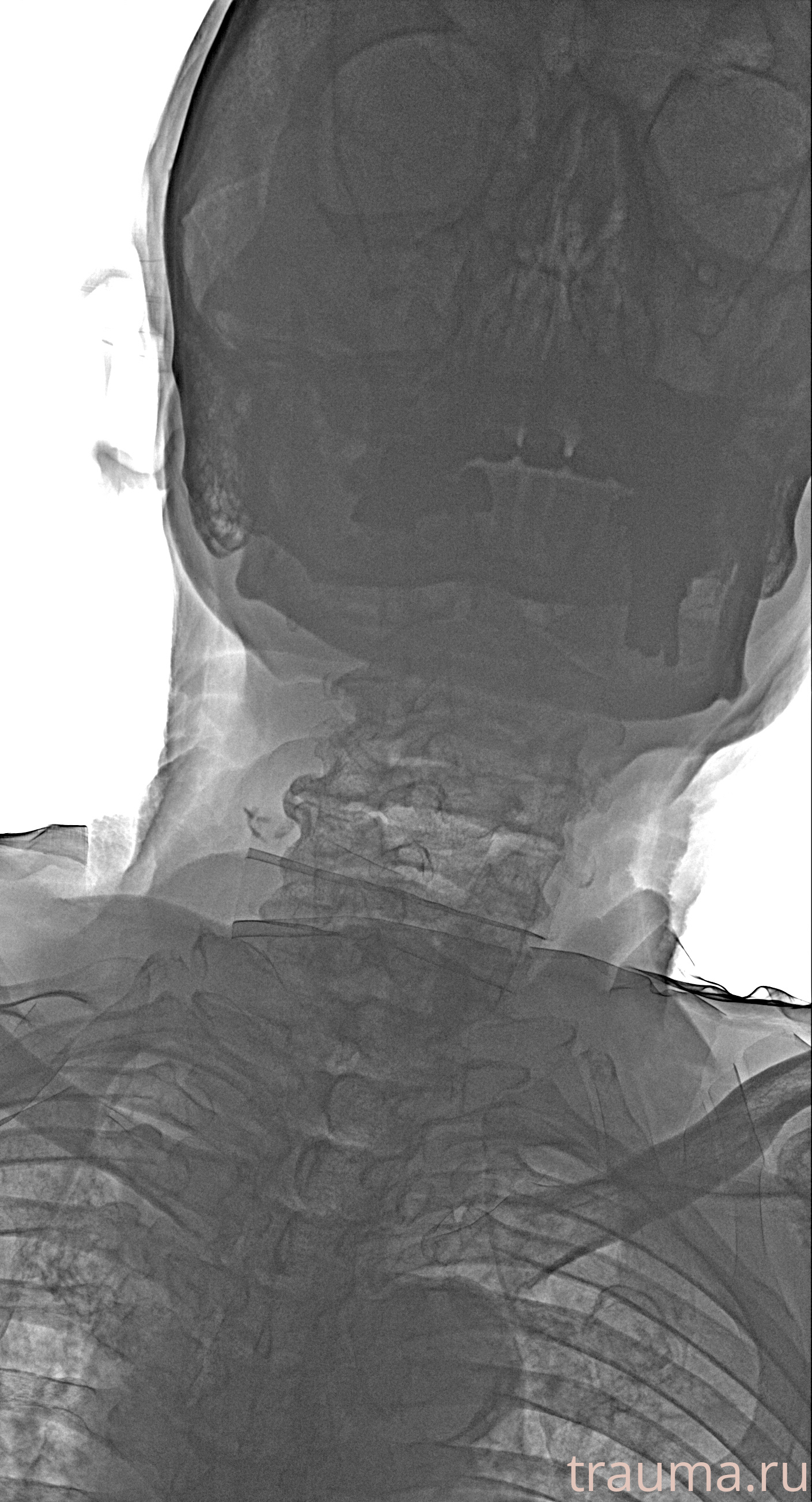 Рентген на дому: по вашему адресу приезжает врач-рентгенолог, травматолог-ортопед с мобильным рентгеновским аппаратом, проводит диагностику травмы или заболевания, делает необходимые рентгенограммы, дает рекомендации по дальнейшему лечению. Получить качественные снимки в домашних условиях возможно благодаря уникальной методике, разработанной МосРентген Центром для института  Склифосовского