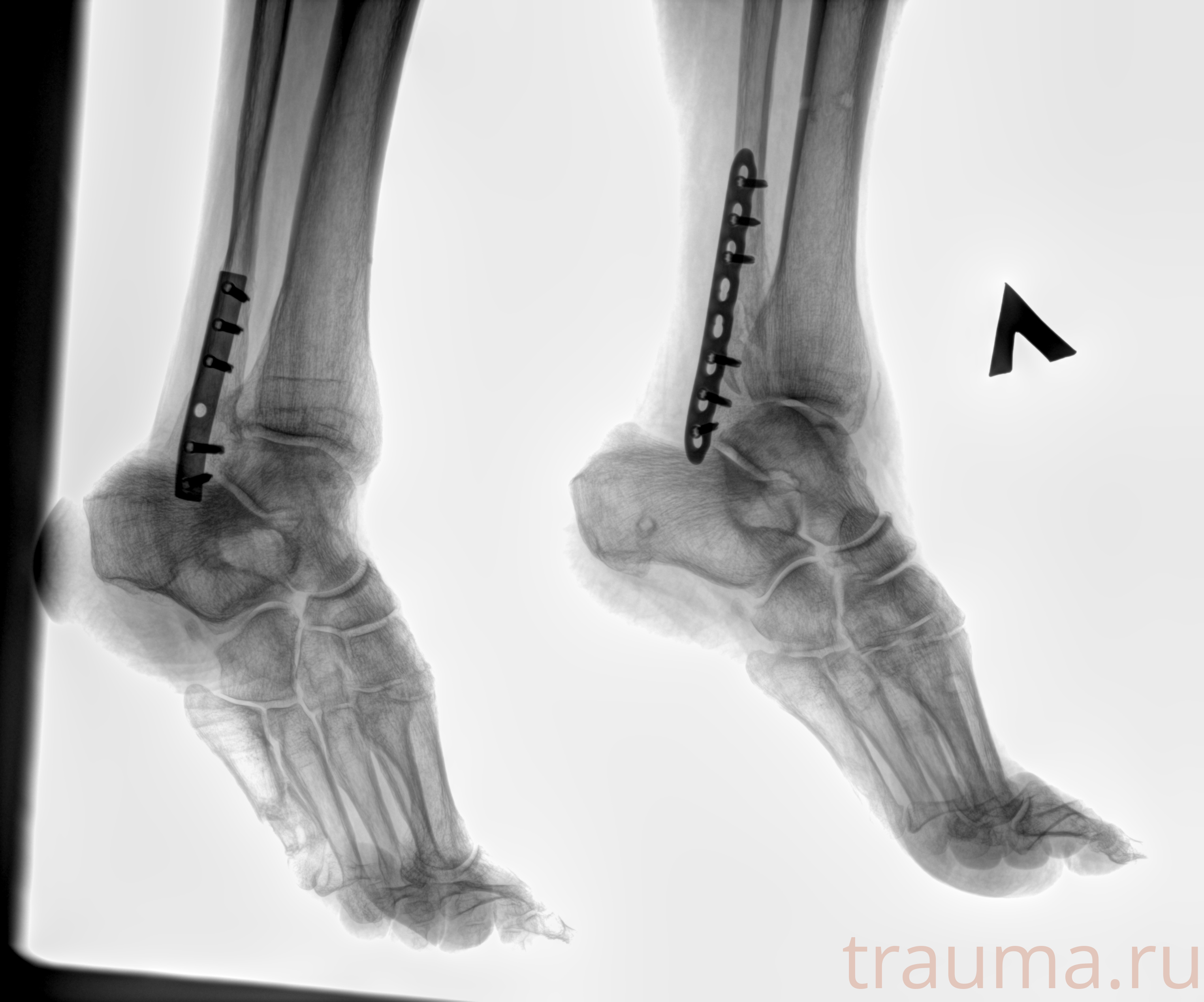 Рентген на дому: по вашему адресу приезжает врач-рентгенолог, травматолог-ортопед с мобильным рентгеновским аппаратом, проводит диагностику травмы или заболевания, делает необходимые рентгенограммы, дает рекомендации по дальнейшему лечению. Получить качественные снимки в домашних условиях возможно благодаря уникальной методике, разработанной МосРентген Центром для института  Склифосовского