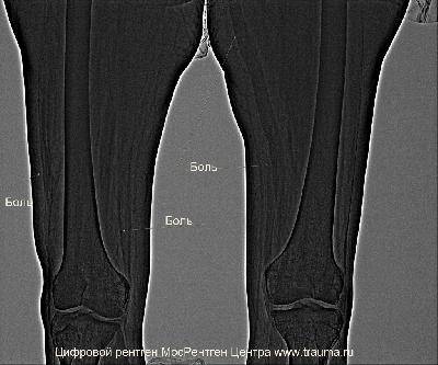 Невропатия бедренного нерва с парезом четырехглавой мышцы на рентгенограмме