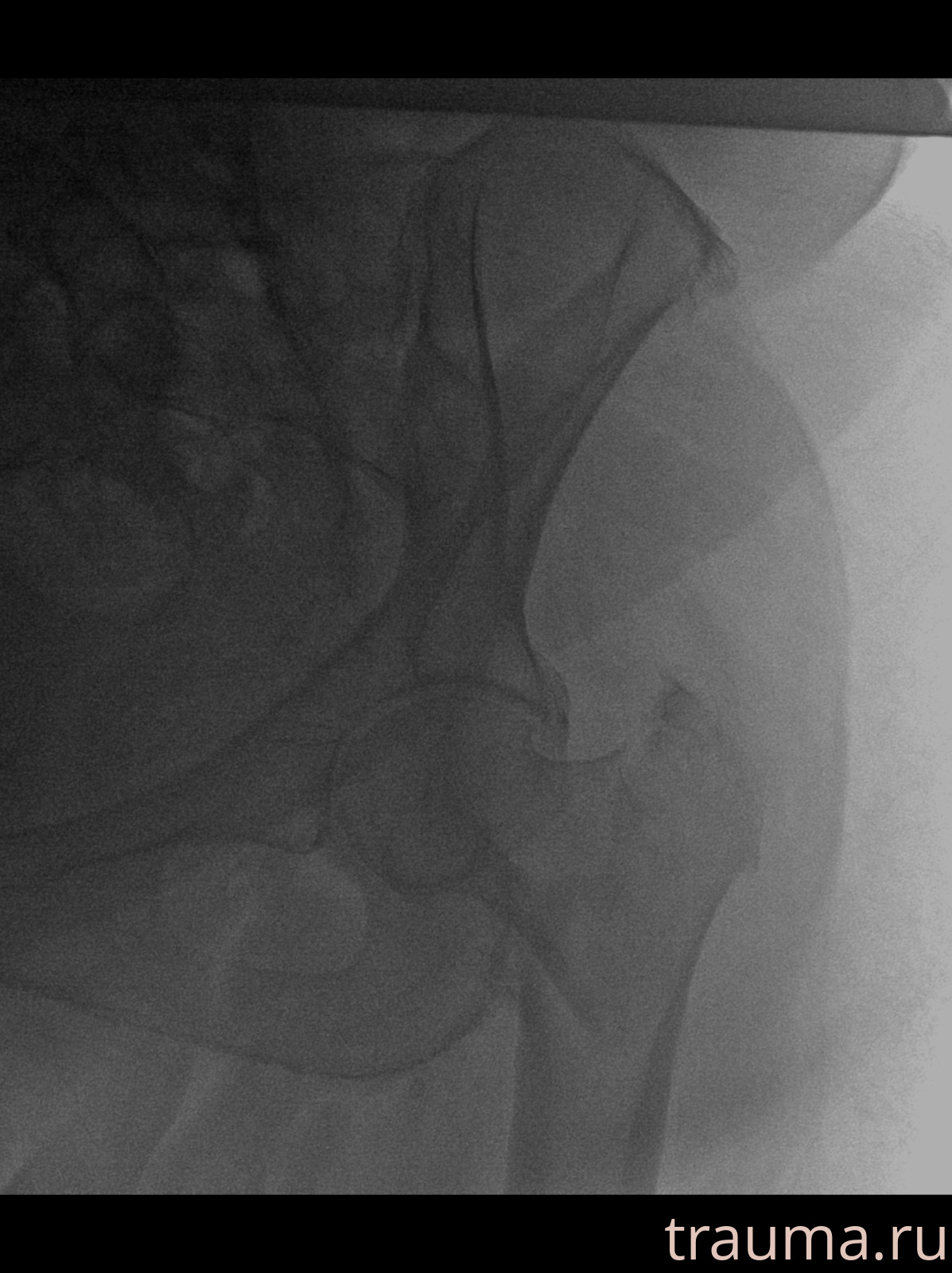 Рентген на дому: по вашему адресу приезжает врач-рентгенолог, травматолог-ортопед с мобильным рентгеновским аппаратом, проводит диагностику травмы или заболевания, делает необходимые рентгенограммы, дает рекомендации по дальнейшему лечению. Получить качественные снимки в домашних условиях возможно благодаря уникальной методике, разработанной МосРентген Центром для института  Склифосовского