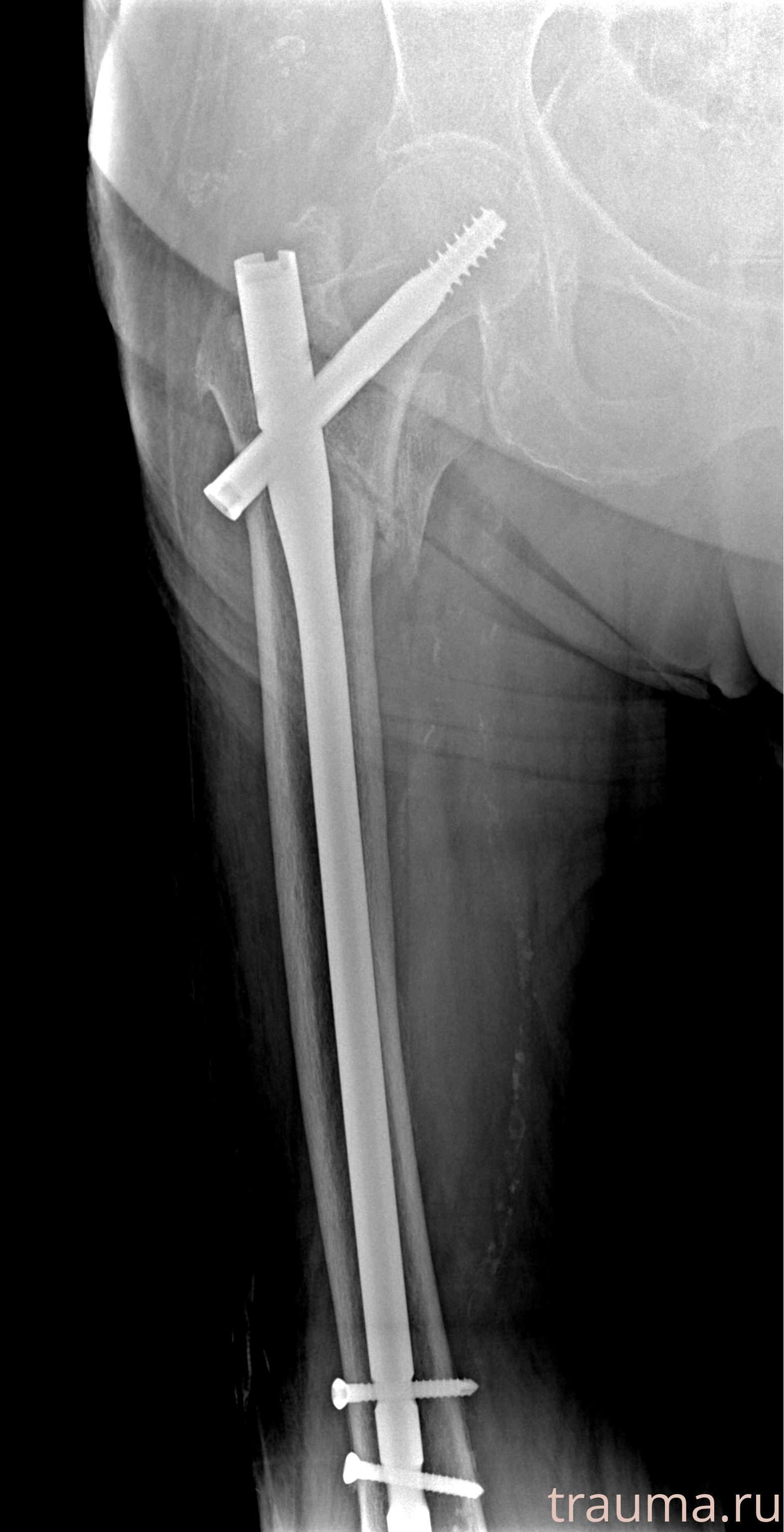 Рентген на дому: по вашему адресу приезжает врач-рентгенолог, травматолог-ортопед с мобильным рентгеновским аппаратом, проводит диагностику травмы или заболевания, делает необходимые рентгенограммы, дает рекомендации по дальнейшему лечению. Получить качественные снимки в домашних условиях возможно благодаря уникальной методике, разработанной МосРентген Центром для института  Склифосовского