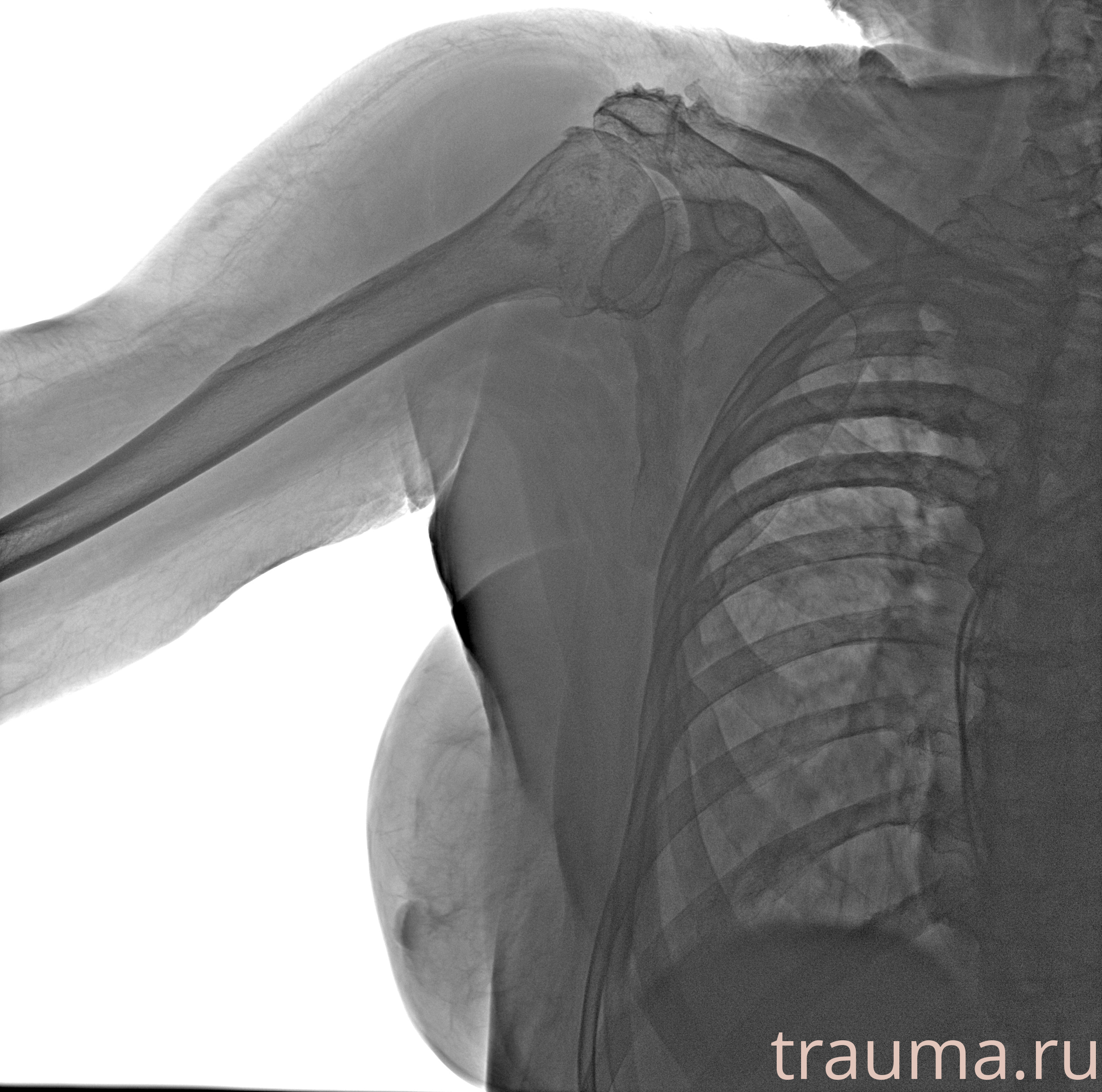 Рентген на дому: по вашему адресу приезжает врач-рентгенолог, травматолог-ортопед с мобильным рентгеновским аппаратом, проводит диагностику травмы или заболевания, делает необходимые рентгенограммы, дает рекомендации по дальнейшему лечению. Получить качественные снимки в домашних условиях возможно благодаря уникальной методике, разработанной МосРентген Центром для института  Склифосовского