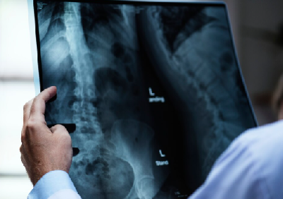 Ученые ЮФУ создали программу анализа рентгена за 1-2 секунды без врача