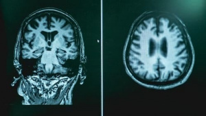 Методика магнитно-резонансной томографии при черепно-мозговой травме у детей