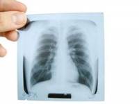 Что лучше: рентген легких или флюорография?