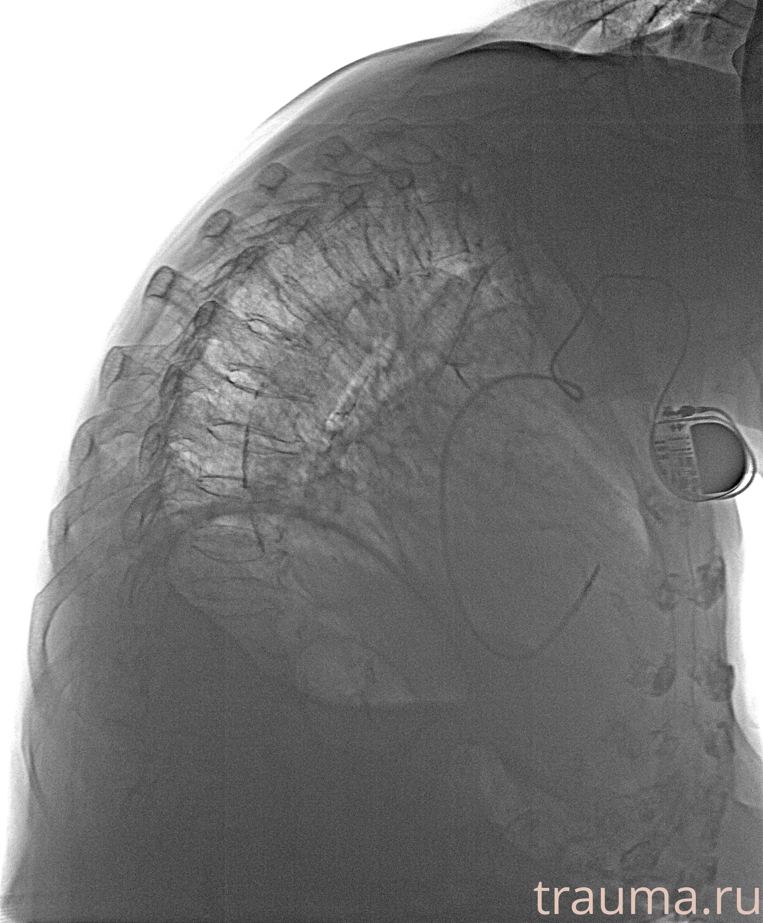 Рентген на дому: по вашему адресу приезжает врач-рентгенолог, травматолог-ортопед с мобильным рентгеновским аппаратом, проводит диагностику травмы или заболевания, делает необходимые рентгенограммы, дает рекомендации по дальнейшему лечению. Получить качественные снимки в домашних условиях возможно благодаря уникальной методике, разработанной МосРентген Центром для института  Склифосовского