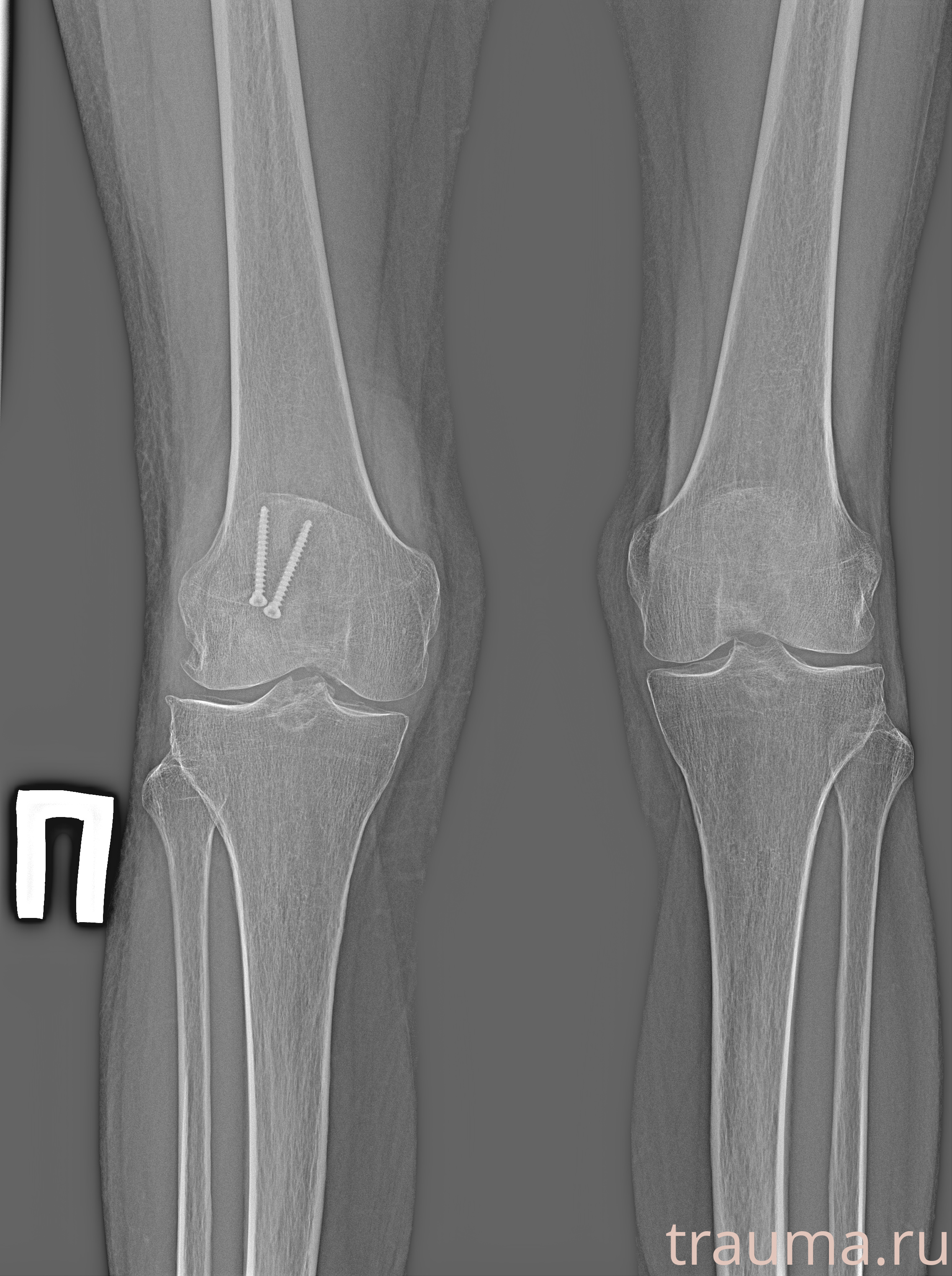 Рентген на дому: по вашему адресу приезжает врач-рентгенолог, травматолог-ортопед с мобильным рентгеновским аппаратом, проводит диагностику травмы или заболевания, делает необходимые рентгенограммы, дает рекомендации по дальнейшему лечению. Получить качественные снимки в домашних условиях возможно благодаря уникальной методике, разработанной МосРентген Центром для института  Склифосовского