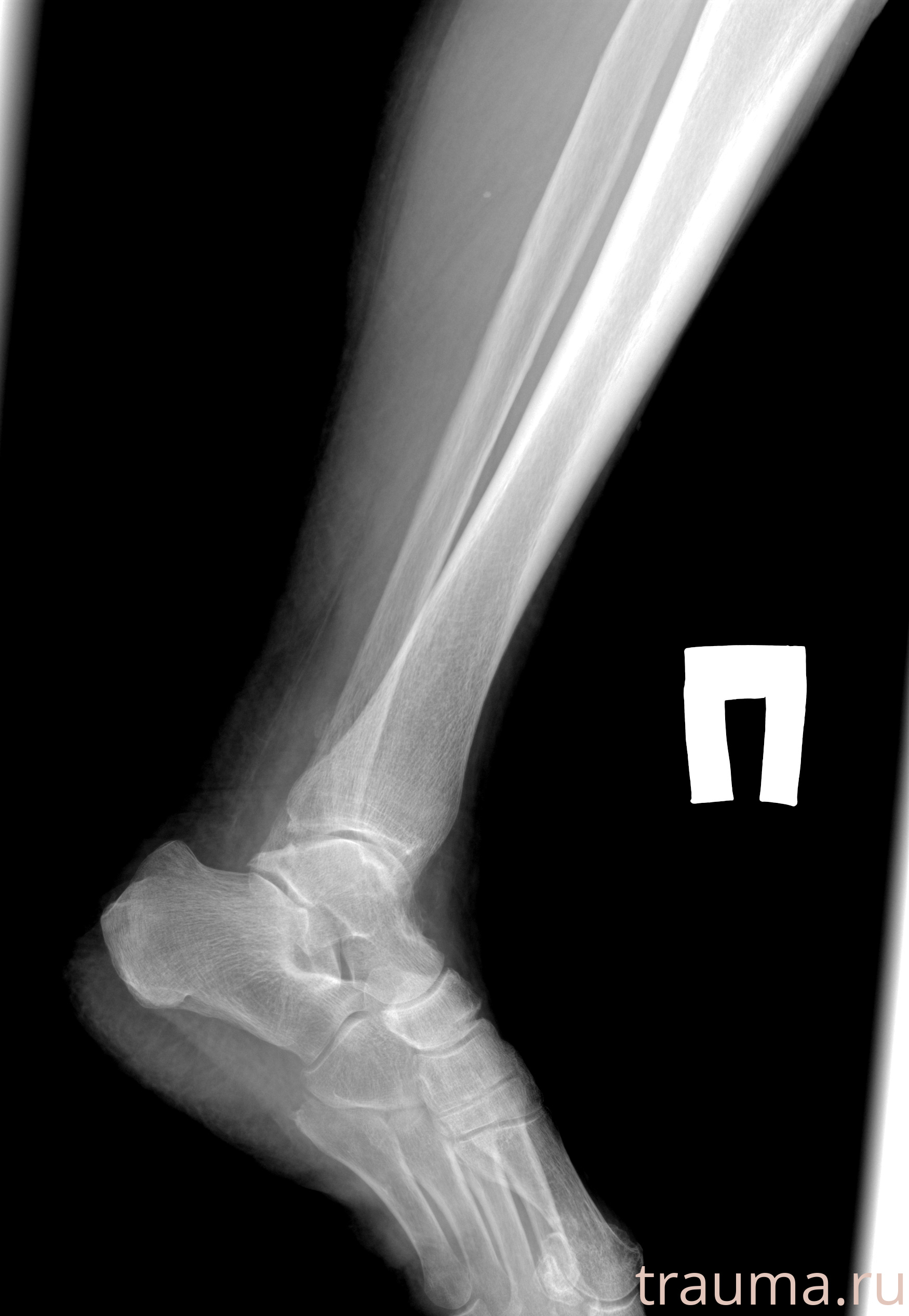 Рентген на дому: по вашему адресу приезжает врач-рентгенолог, травматолог-ортопед с мобильным рентгеновским аппаратом, проводит диагностику травмы или заболевания, делает необходимые рентгенограммы, дает рекомендации по дальнейшему лечению. Получить качественные снимки в домашних условиях возможно благодаря уникальной методике, разработанной МосРентген Центром для института  Склифосовского