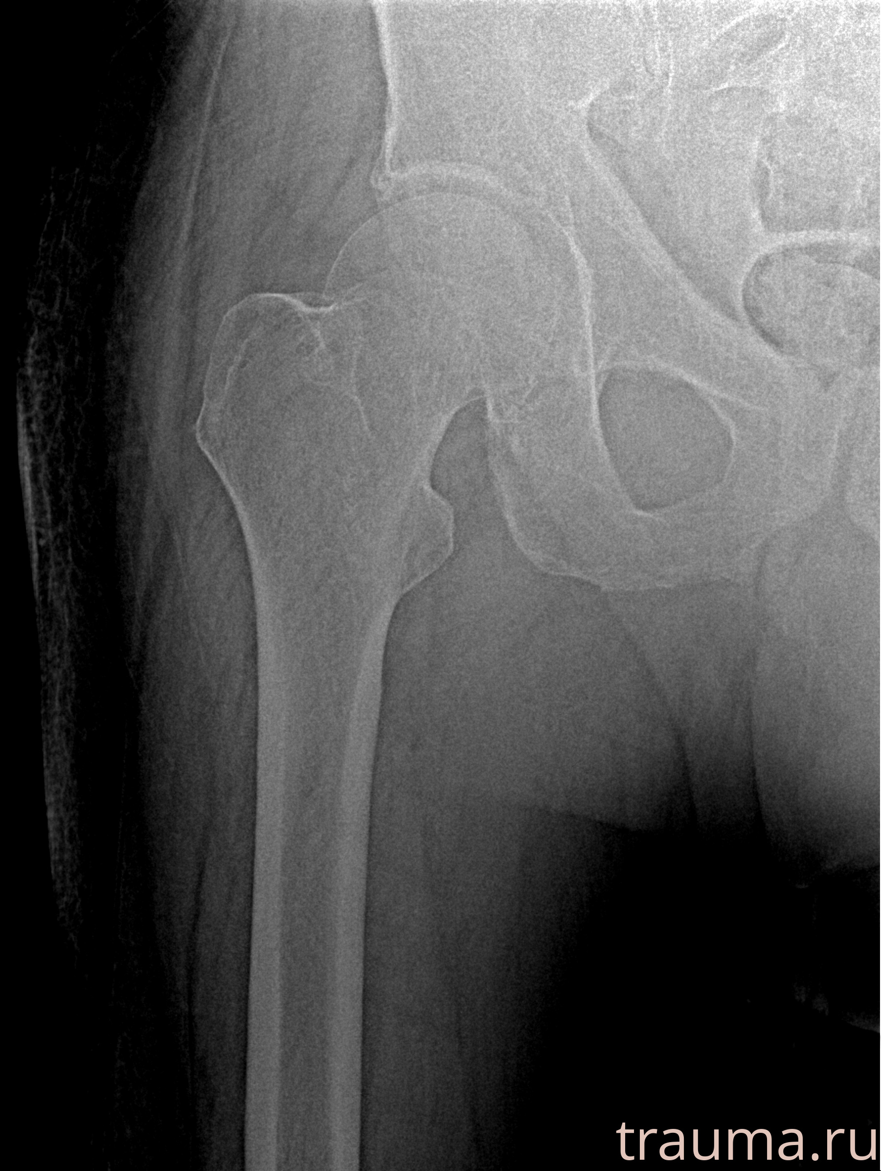 Рентген на дому: по вашему адресу приезжает врач-рентгенолог, травматолог-ортопед с мобильным рентгеновским аппаратом, проводит диагностику травмы или заболевания, делает необходимые рентгенограммы, дает рекомендации по дальнейшему лечению. Получить качественные снимки в домашних условиях возможно благодаря уникальной методике, разработанной МосРентген Центром для института  Склифосовского