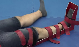 Случай успешной реконструктивной операции при тяжелой открытой травме голени с нарушением кровообращения