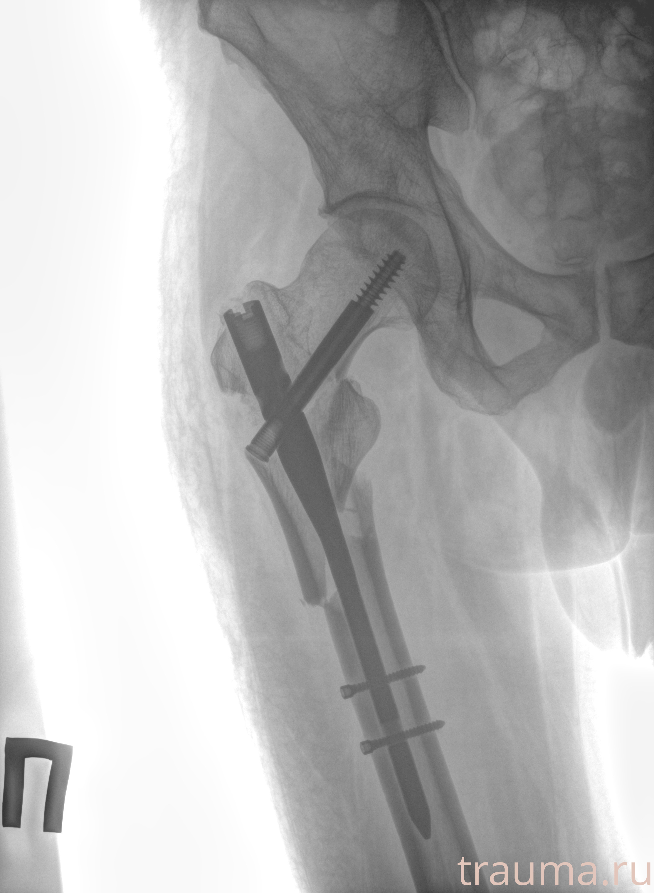 Рентген на дому: по вашему адресу приезжает врач-рентгенолог, травматолог-ортопед с мобильным рентгеновским аппаратом, проводит диагностику травмы или заболевания, делает необходимые рентгенограммы, дает рекомендации по дальнейшему лечению. Получить качественные снимки в домашних условиях возможно благодаря уникальной методике, разработанной МосРентген Центром для института  Склифосовского