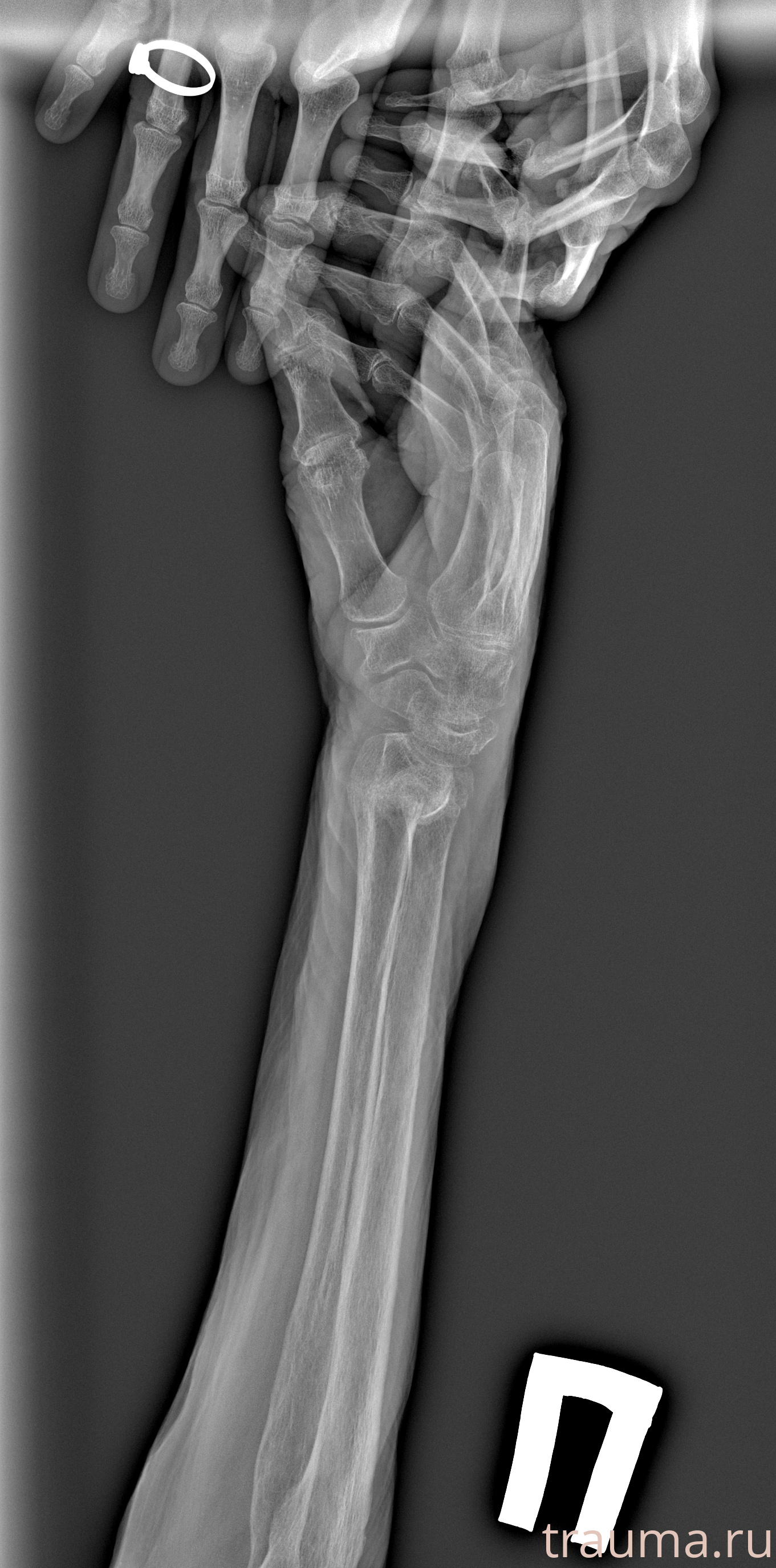 Рентген на дому: по вашему адресу приезжает врач-рентгенолог, травматолог-ортопед с мобильным рентгеновским аппаратом, проводит диагностику травмы или заболевания, делает необходимые рентгенограммы, дает рекомендации по дальнейшему лечению. Получить качественные снимки в домашних условиях возможно благодаря уникальной методике, разработанной МосРентген Центром для института  Склифосовского