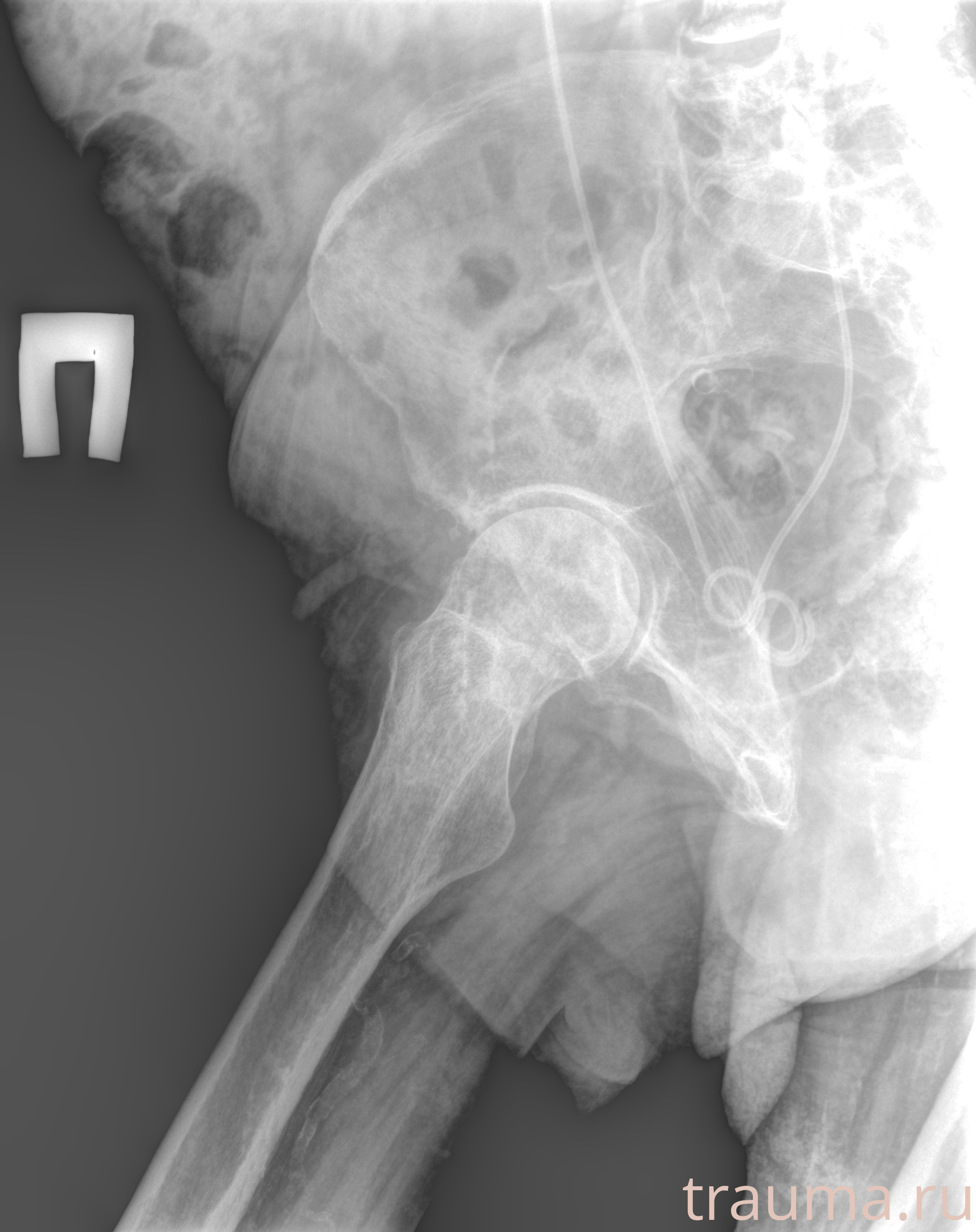 Рентген на дому: по вашему адресу приезжает врач-рентгенолог, травматолог-ортопед с мобильным рентгеновским аппаратом, проводит диагностику травмы или заболевания, делает необходимые рентгенограммы, дает рекомендации по дальнейшему лечению. Получить качественные снимки в домашних условиях возможно благодаря уникальной методике, разработанной МосРентген Центром для института  Склифосовского