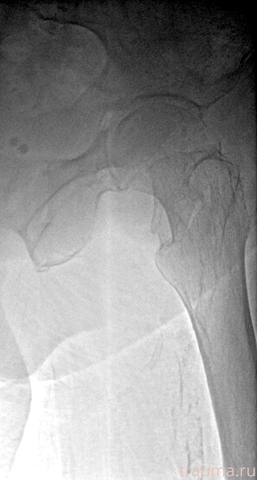 Рентген на дому: по вашему адресу приезжает врач-рентгенолог, травматолог-ортопед с мобильным рентгеновским аппаратом, проводит диагностику травмы или заболевания, делает необходимые рентгенограммы, дает рекомендации по дальнейшему лечению. Получить качественные снимки в домашних условиях возможно благодаря уникальной методике, разработанной МосРентген Центром для института  Склифосовского