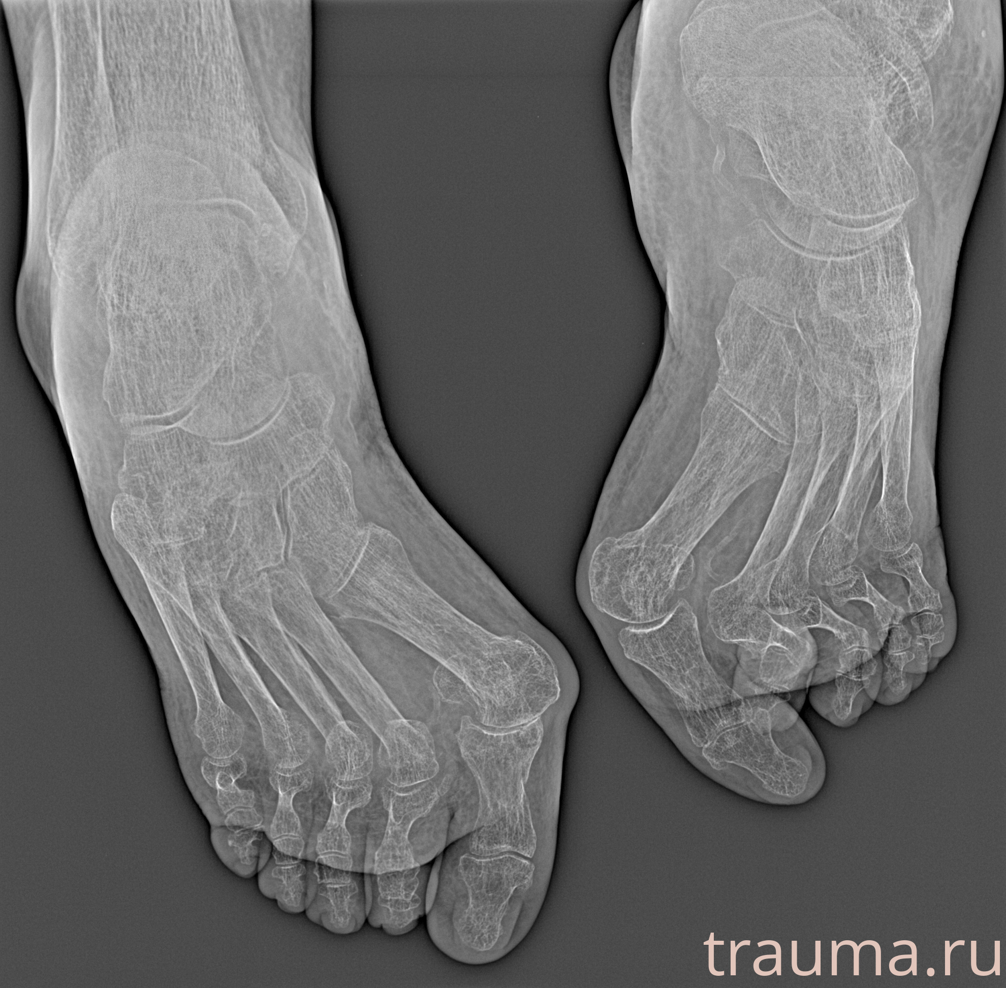 Рентген на дому: по вашему адресу приезжает врач-рентгенолог, травматолог-ортопед с мобильным рентгеновским аппаратом, проводит диагностику травмы или заболевания, делает необходимые рентгенограммы, дает рекомендации по дальнейшему лечению. Получить качественные снимки в домашних условиях возможно благодаря уникальной методике, разработанной МосРентген Центром для института  Склифосовского