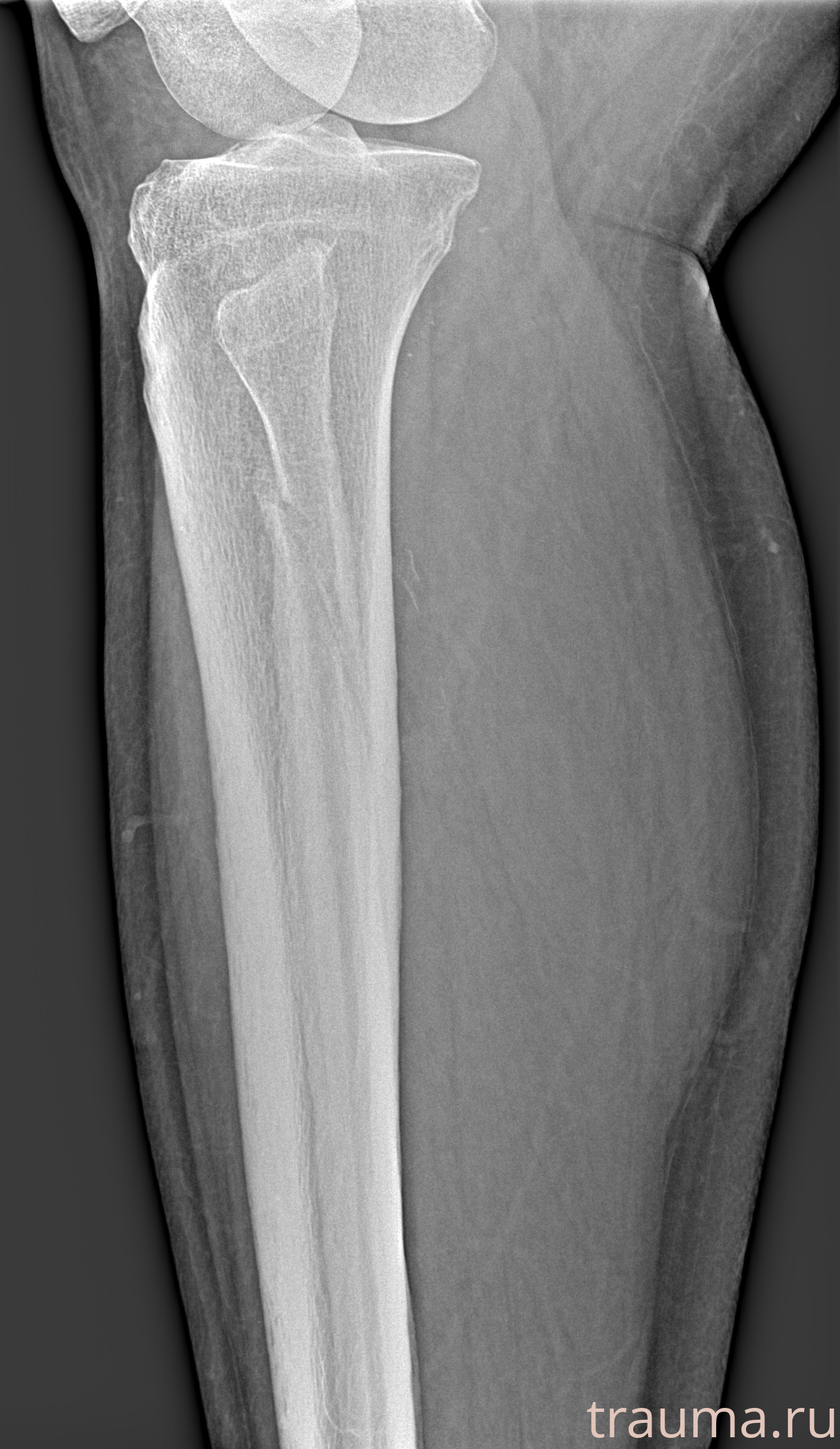 Рентген на дому: по вашему адресу приезжает врач-рентгенолог, травматолог-ортопед с мобильным рентгеновским аппаратом, проводит диагностику травмы или заболевания, делает необходимые рентгенограммы, дает рекомендации по дальнейшему лечению. Получить качественные снимки в домашних условиях возможно благодаря уникальной методике, разработанной МосРентген Центром для института  Склифосовского