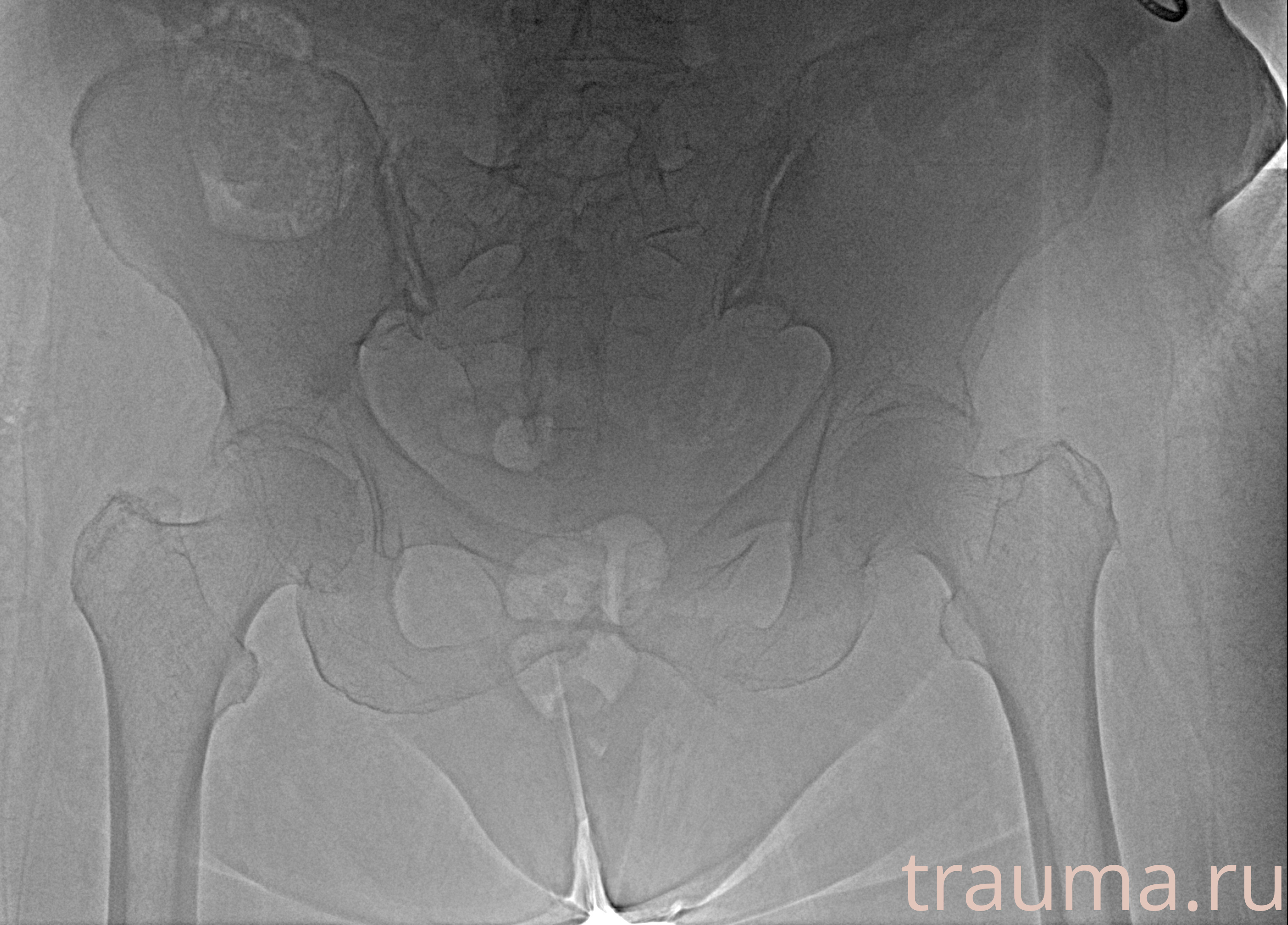 Рентген на дому: по вашему адресу приезжает врач-рентгенолог, травматолог-ортопед с мобильным рентгеновским аппаратом, проводит диагностику травмы или заболевания, делает необходимые рентгенограммы, дает рекомендации по дальнейшему лечению. Получить качественные снимки в домашних условиях возможно благодаря уникальной методике, разработанной МосРентген Центром для института  Склифосовского