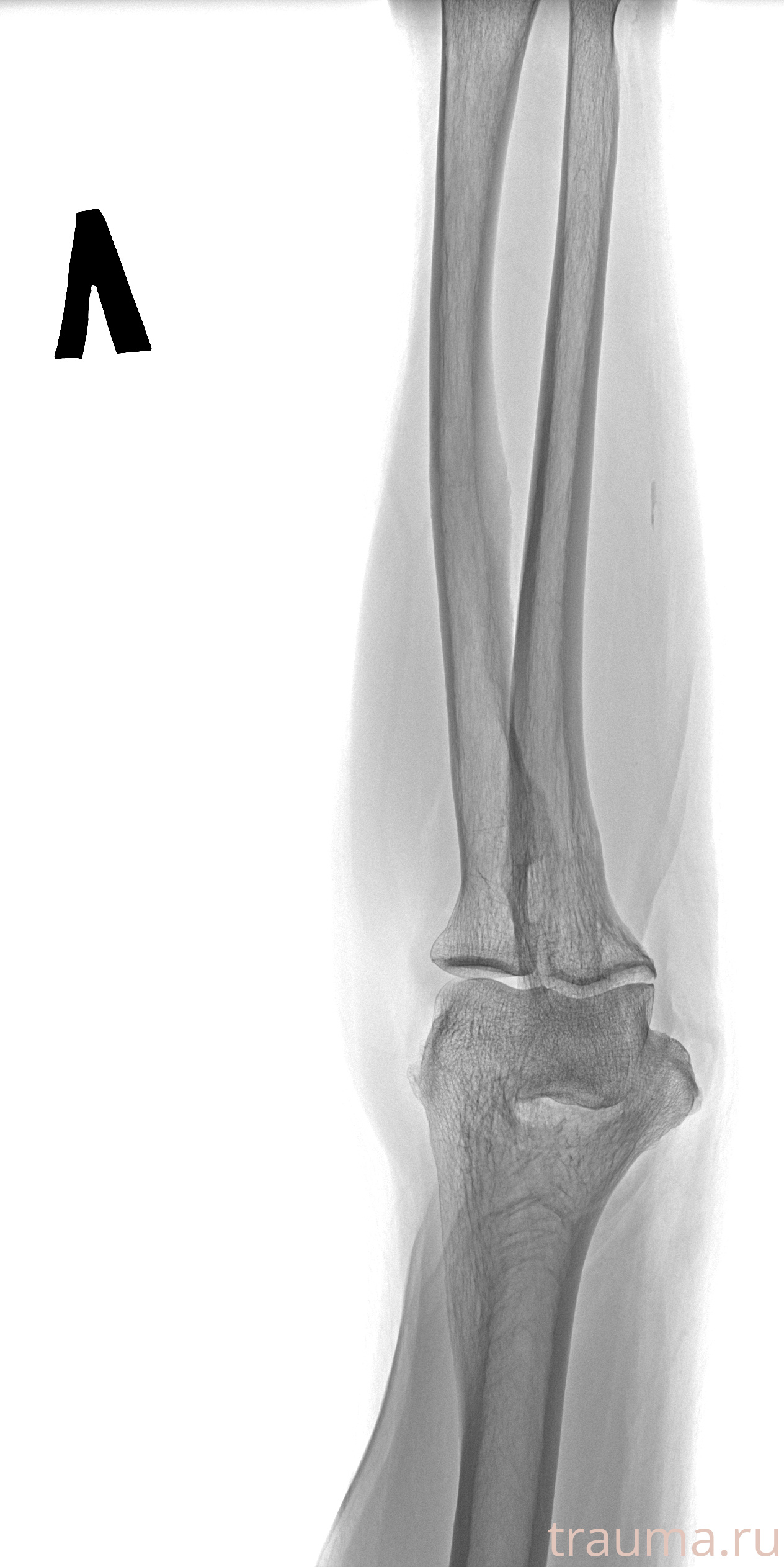 Рентген на дому: по вашему адресу приезжает врач-рентгенолог, травматолог-ортопед с мобильным рентгеновским аппаратом, проводит диагностику травмы или заболевания, делает необходимые рентгенограммы, дает рекомендации по дальнейшему лечению. Получить качественные снимки в домашних условиях возможно благодаря уникальной методике, разработанной МосРентген Центром для института  Склифосовского