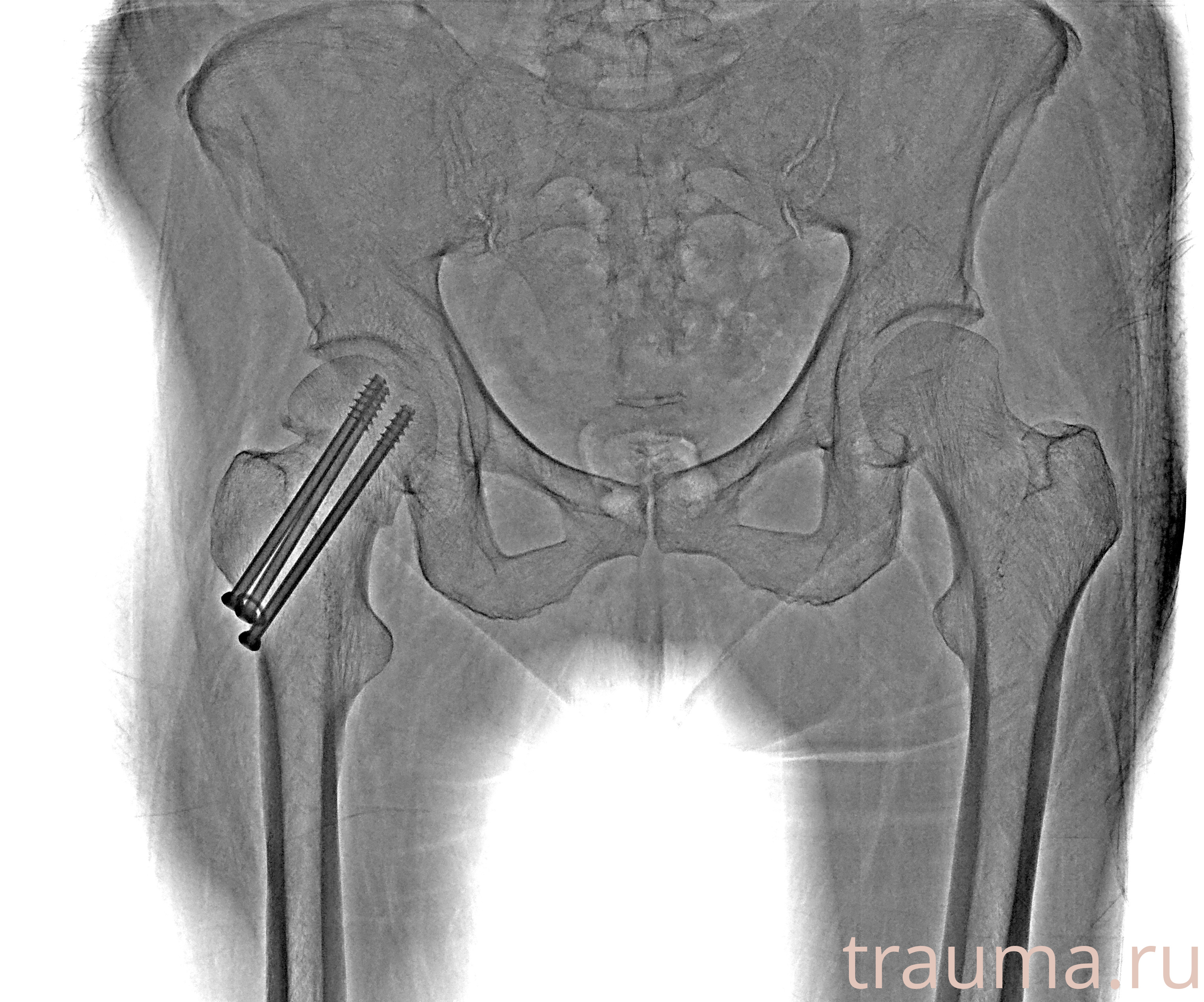 Рентген на дому: по вашему адресу приезжает врач-рентгенолог, травматолог-ортопед с мобильным рентгеновским аппаратом, проводит диагностику травмы или заболевания, делает необходимые рентгенограммы, дает рекомендации по дальнейшему лечению. Получить качественные снимки в домашних условиях возможно благодаря уникальной методике, разработанной МосРентген Центром для института  Склифосовского