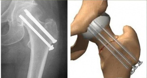 Социально-гигиеническая и клинико-диагностическая характеристики пациентов, пролеченных методом внеочаговой фиксации по поводу переломов костей скелета
