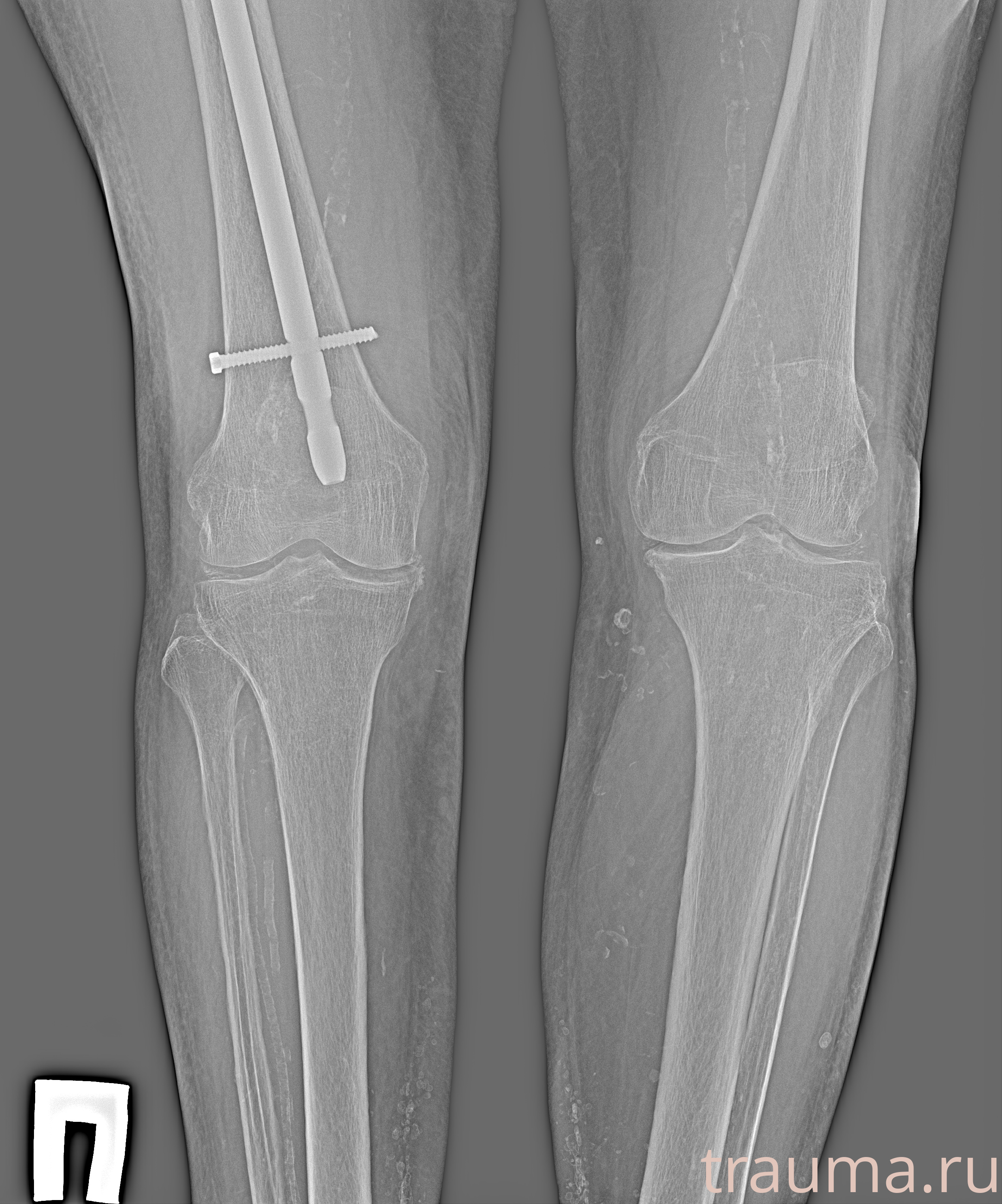 Рентген на дому: по вашему адресу приезжает врач-рентгенолог, травматолог-ортопед с мобильным рентгеновским аппаратом, проводит диагностику травмы или заболевания, делает необходимые рентгенограммы, дает рекомендации по дальнейшему лечению. Получить качественные снимки в домашних условиях возможно благодаря уникальной методике, разработанной МосРентген Центром для института  Склифосовского