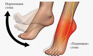 Сравнительная эффективность хирургических методов коррекции синдрома «висящей стопы» при изолированной нейропатии малоберцового нерва