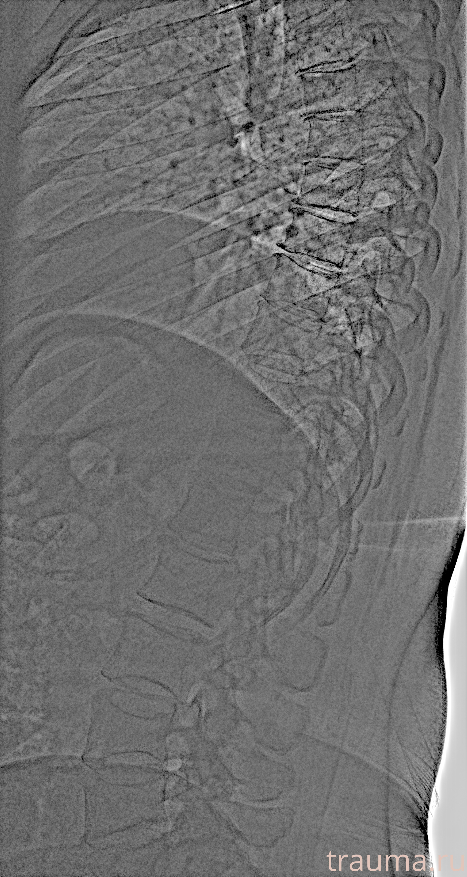 Рентген на дому: по вашему адресу приезжает врач-рентгенолог, травматолог-ортопед с мобильным рентгеновским аппаратом, проводит диагностику травмы или заболевания, делает необходимые рентгенограммы, дает рекомендации по дальнейшему лечению. Получить качественные снимки в домашних условиях возможно благодаря уникальной методике, разработанной МосРентген Центром для института  Склифосовского